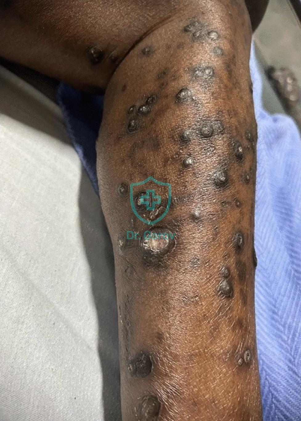 Keratosis follicularis et parafollicularis in cutem penetrans [Kyrle