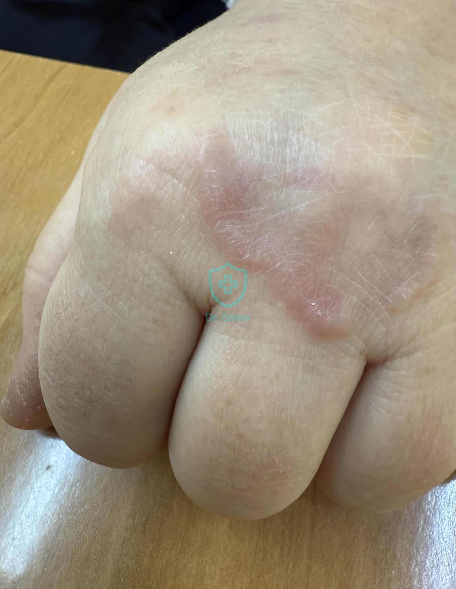 Granuloma annulare