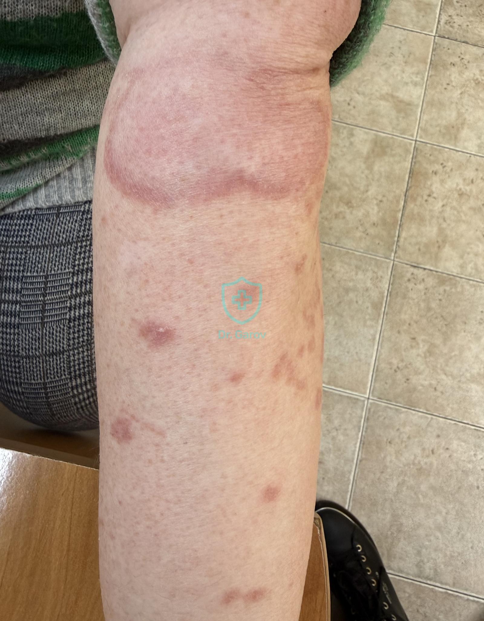 Granuloma annulare