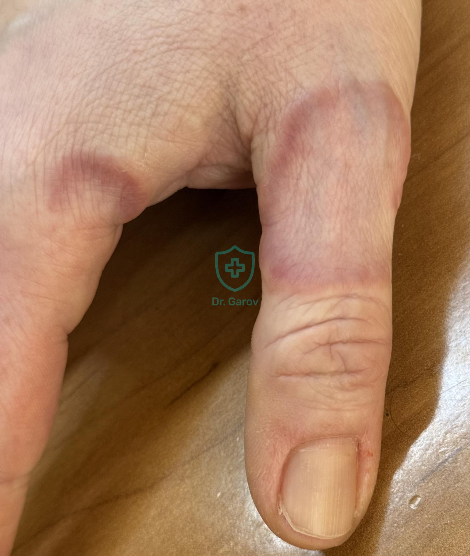 Granuloma annulare