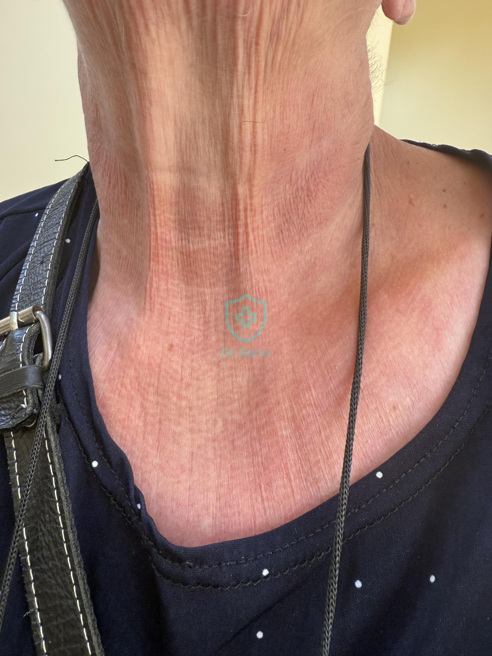 Dermatomyositis