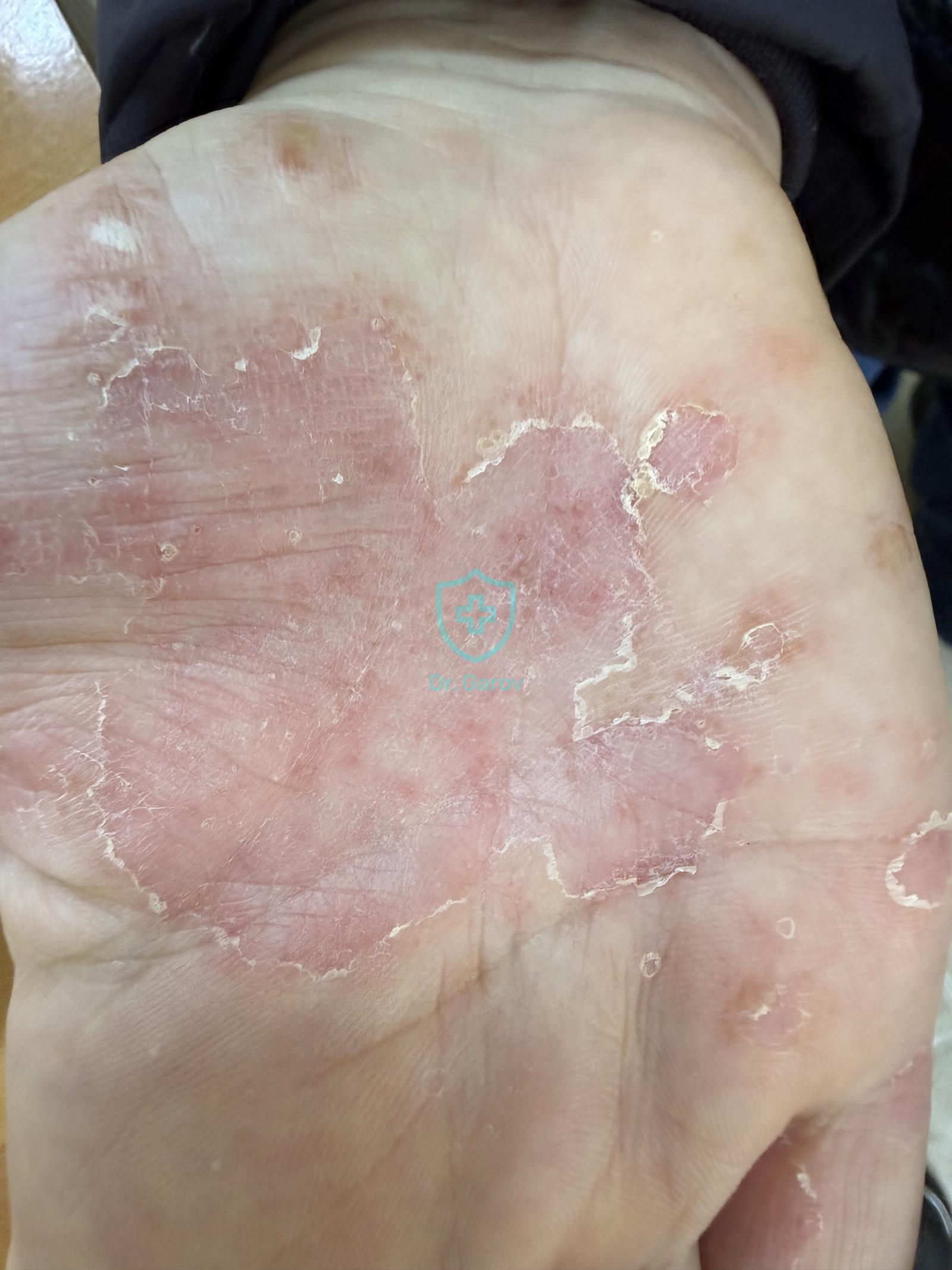 Dyshidrosis, Eczema dyshidrosiforme