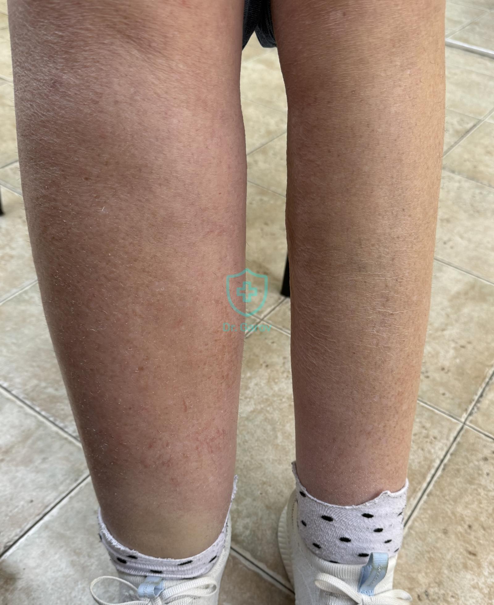 Elephantiasis