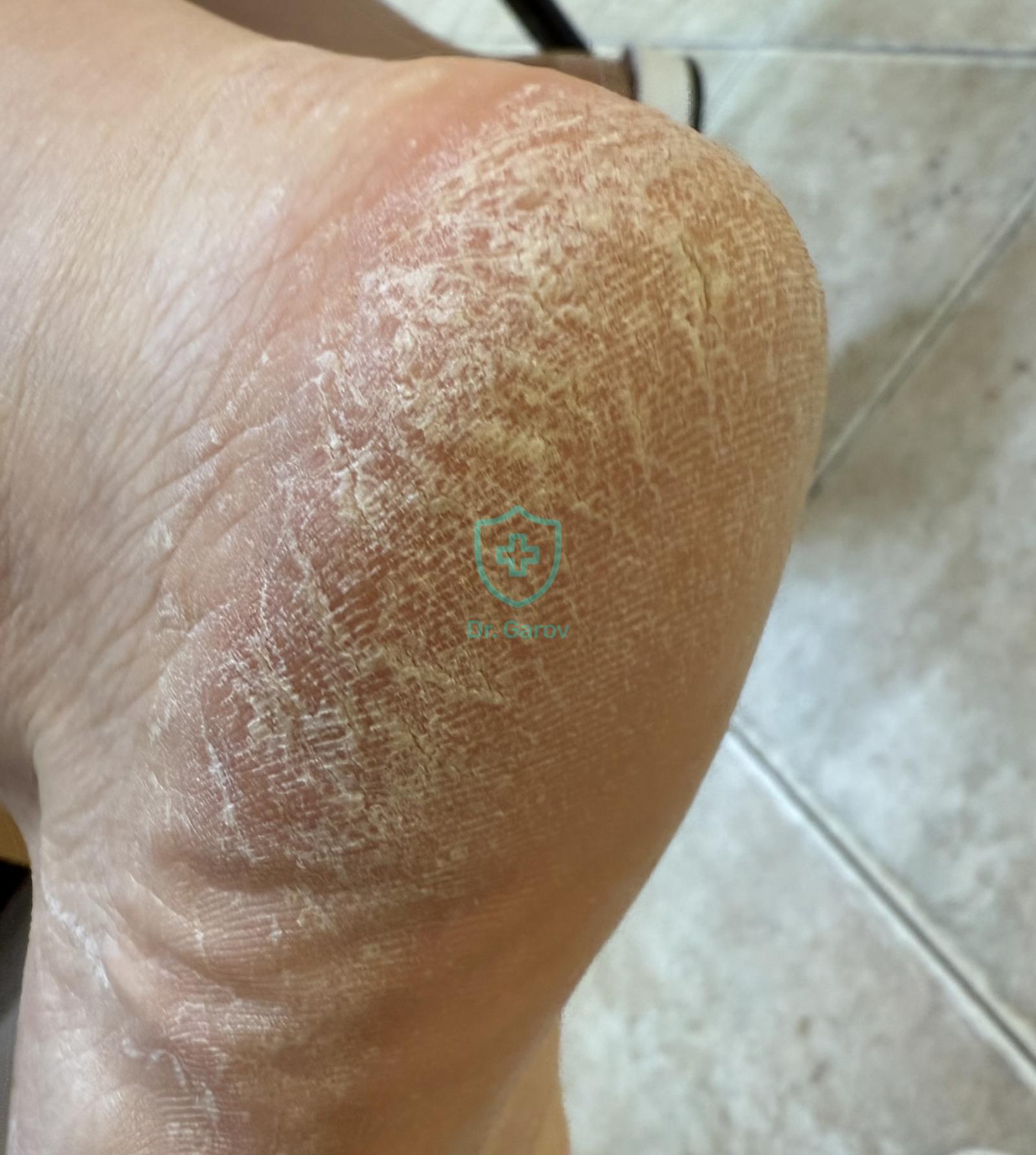 Keratodermia palmo-plantaris klymacterica