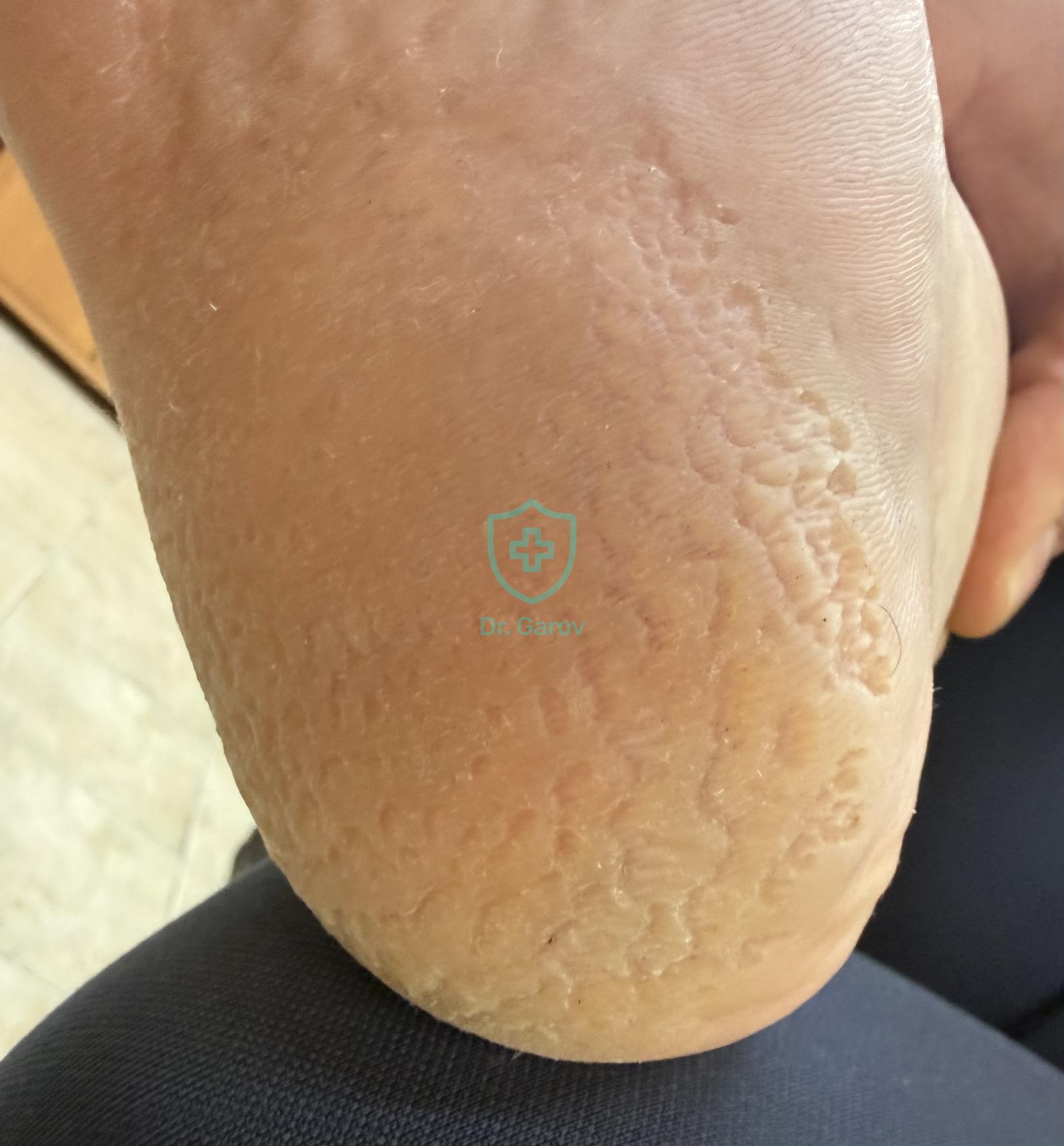 Keratolysis plantare sulcatum, Плантарна кератолиза