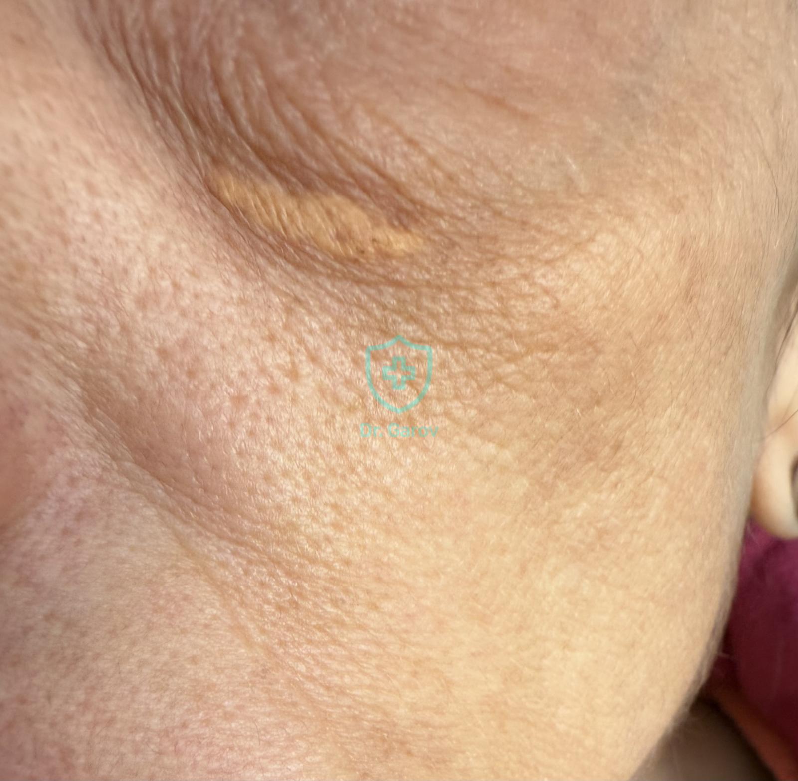 Xanthelasma