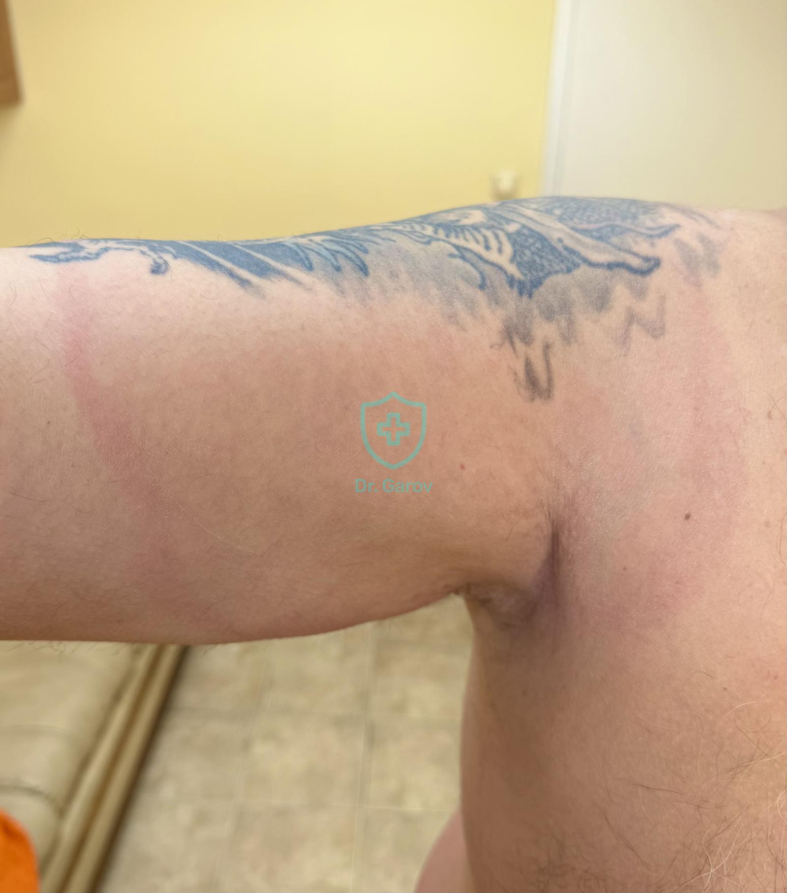 Morbus Lyme - Erythema chronicum migrans