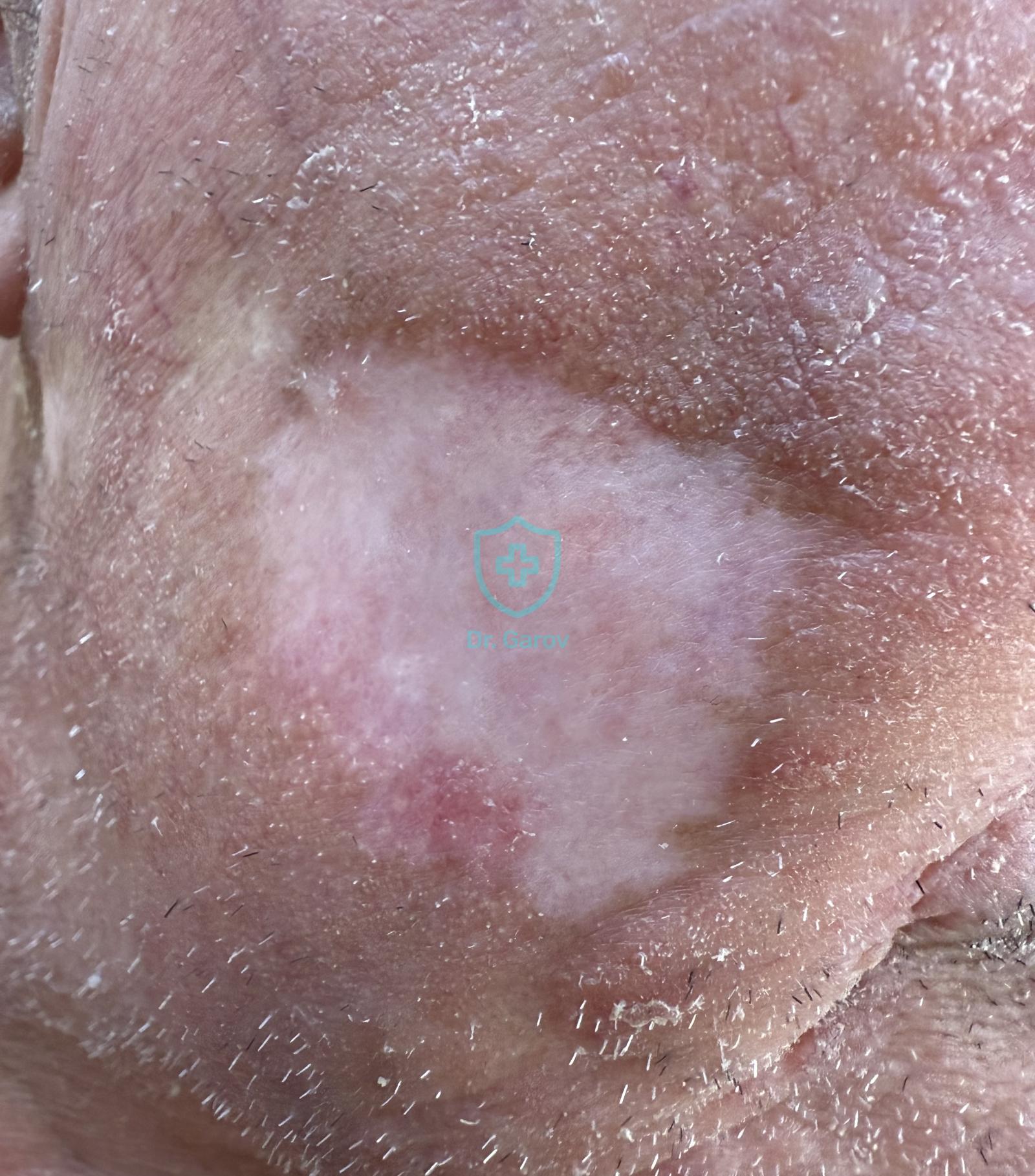 Lupus erythematosus chronicus dyscoides