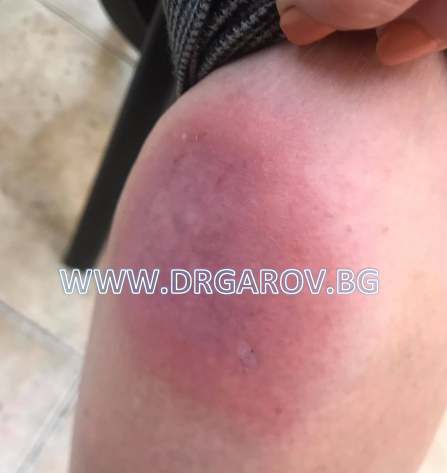 Снимка Медикаментозен дерматит