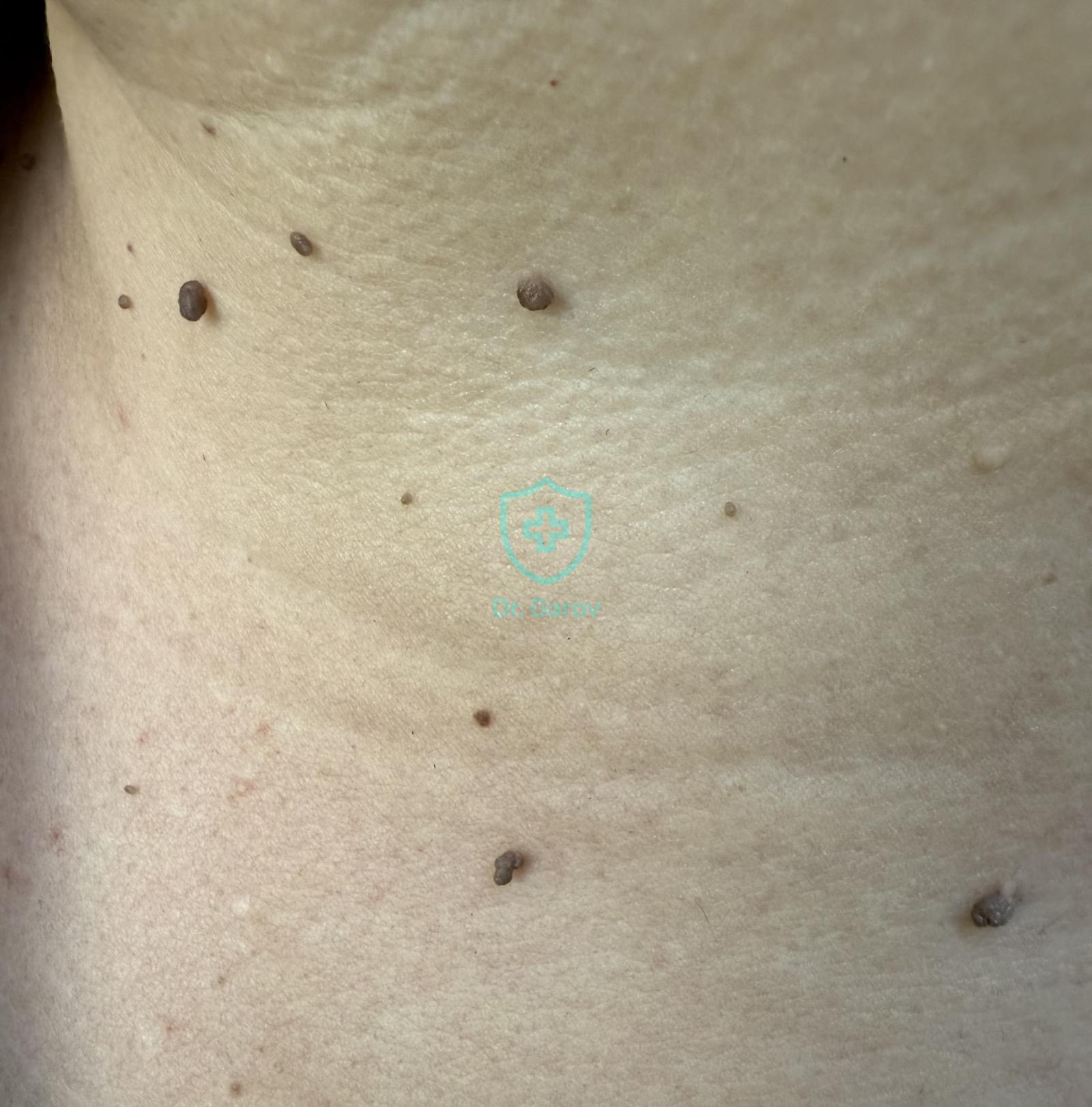 Fibroma molle