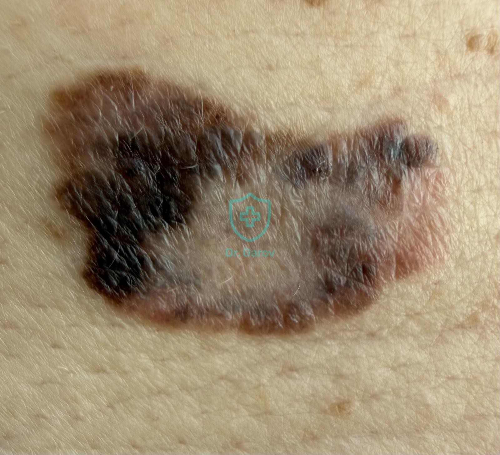 Melanoma malignum, меланома малигнум