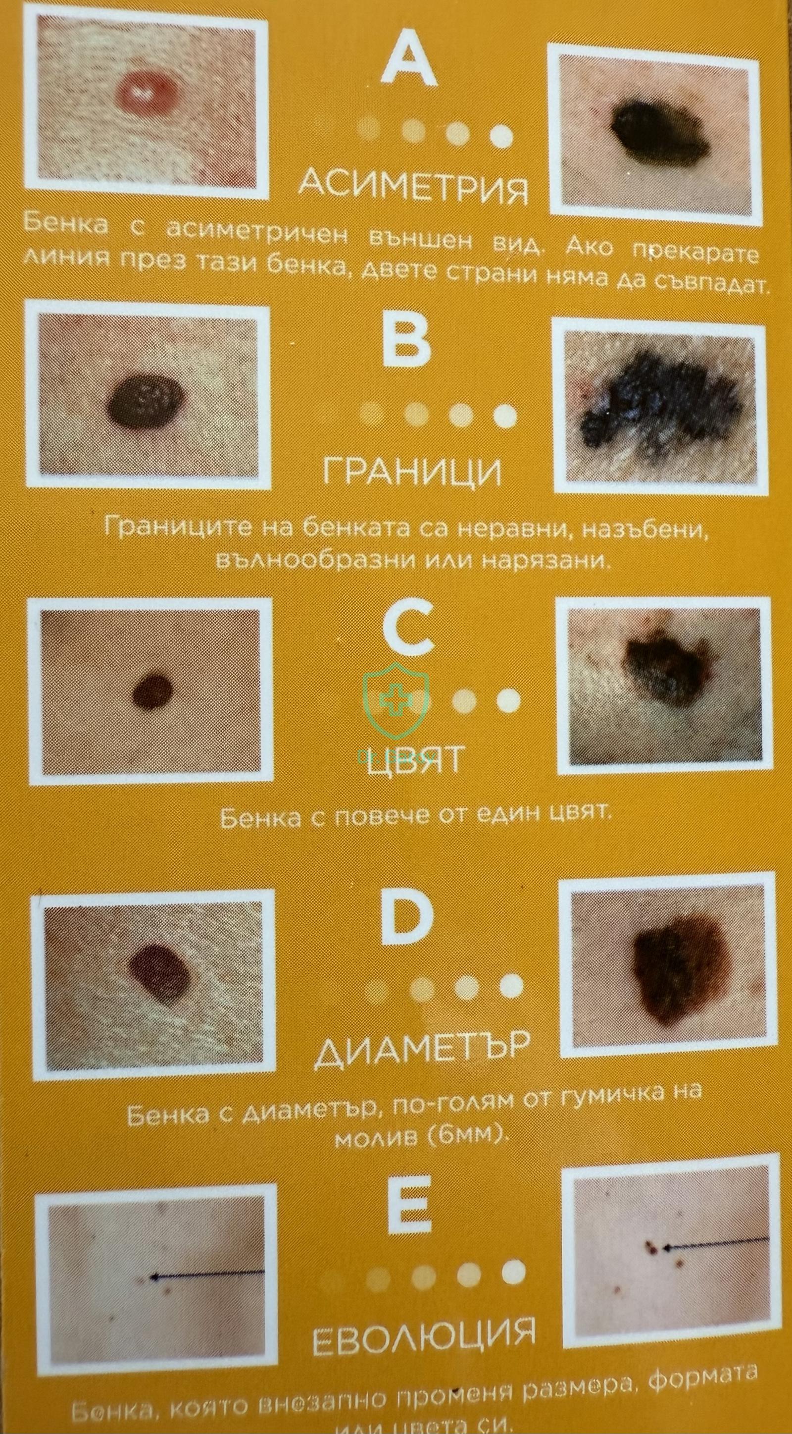 Меланоцитни невуси