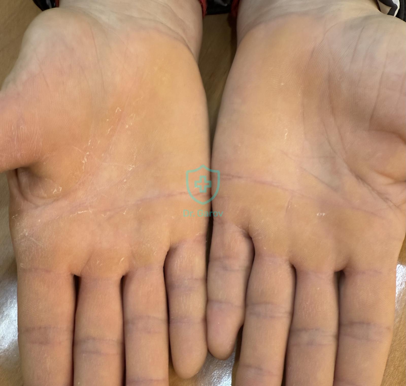 Keratodermia palmo-plantaris klymacterica