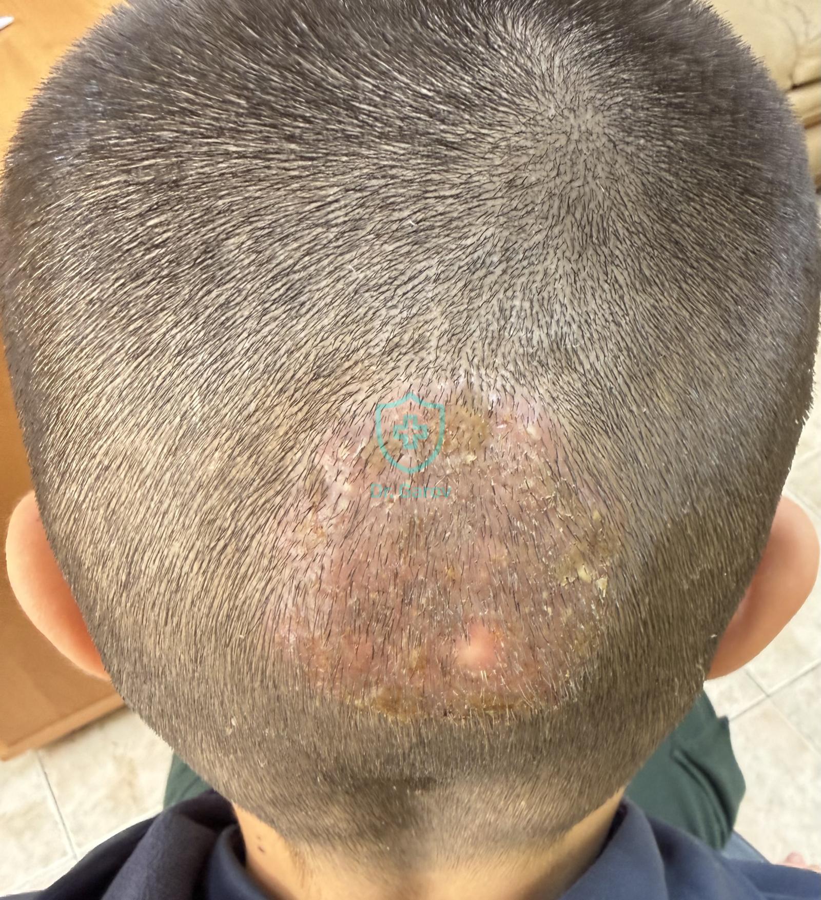 Tinea capitis profunda (Kerion Celsi)