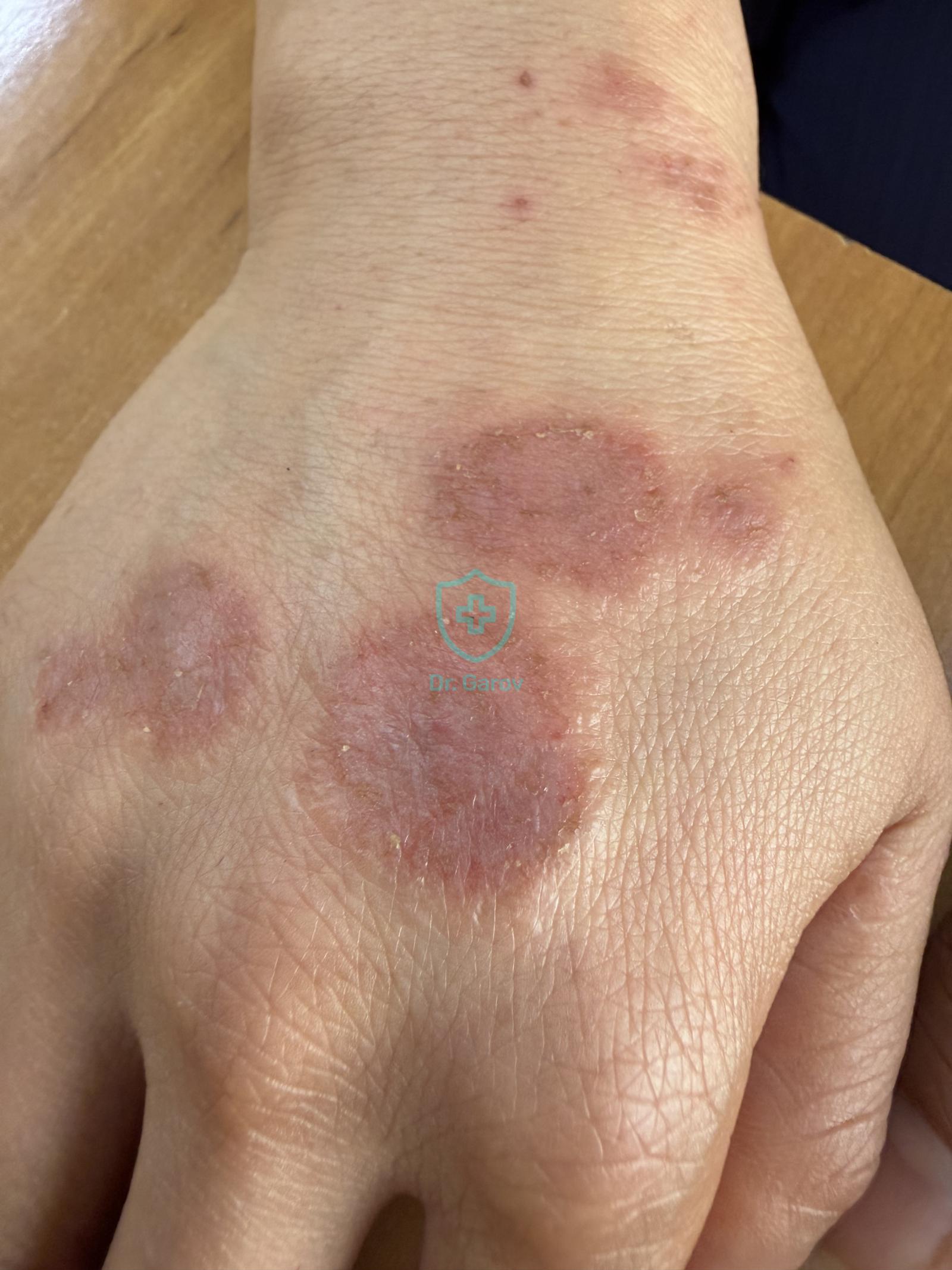 Eczema nummulare