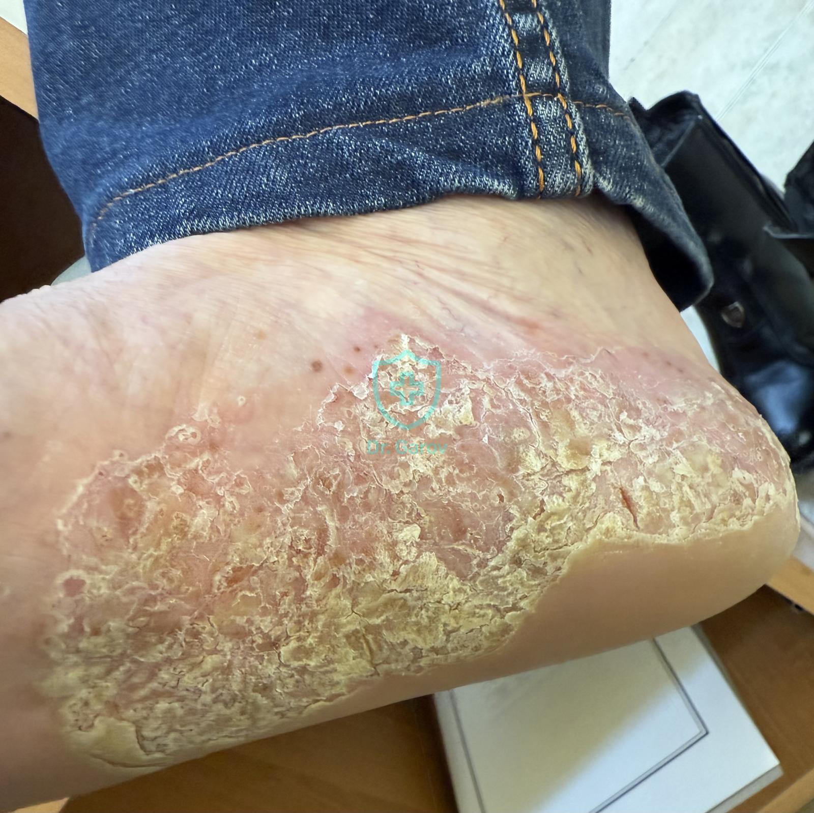 Pustulosis palmaris et plantaris