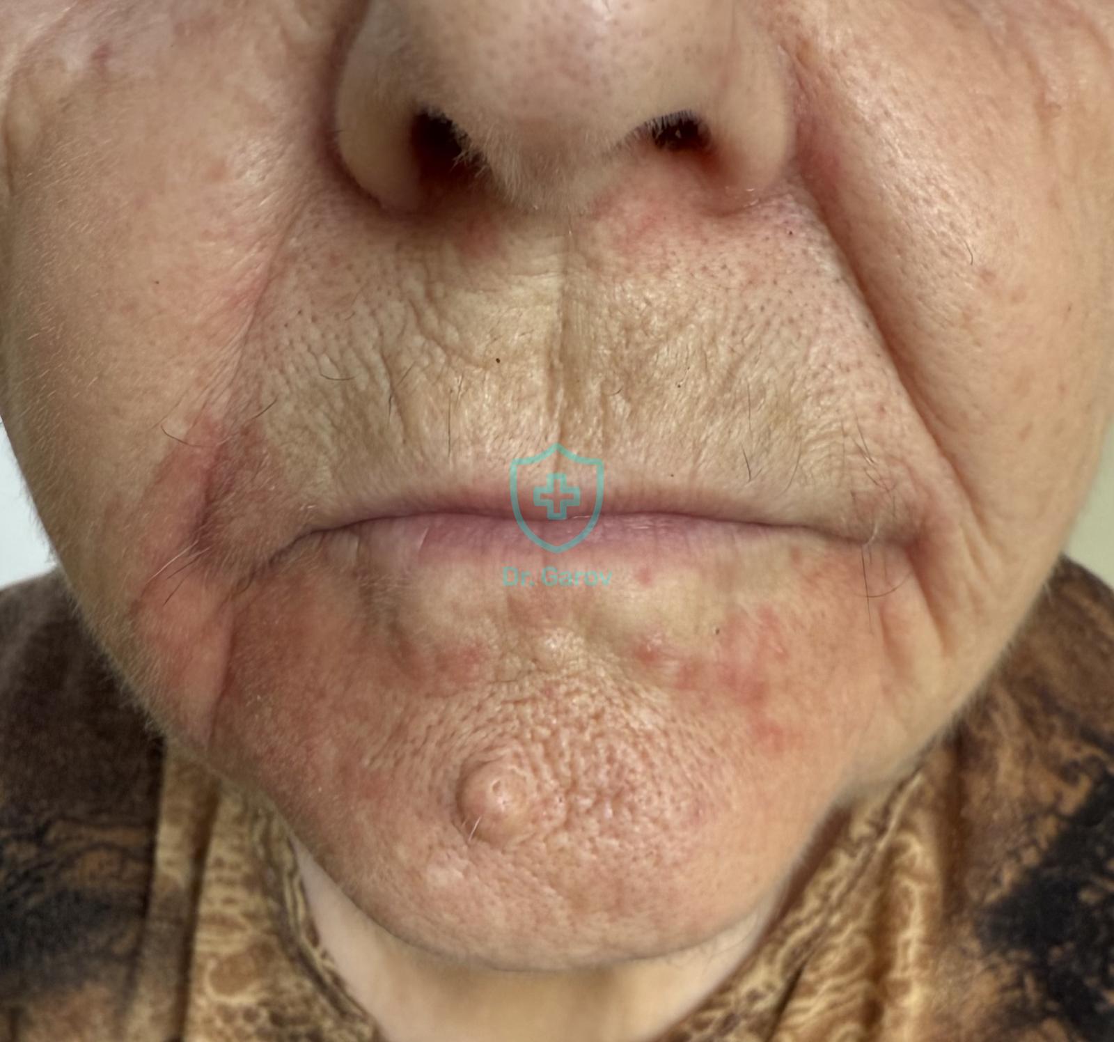 Dermatitis perioralis