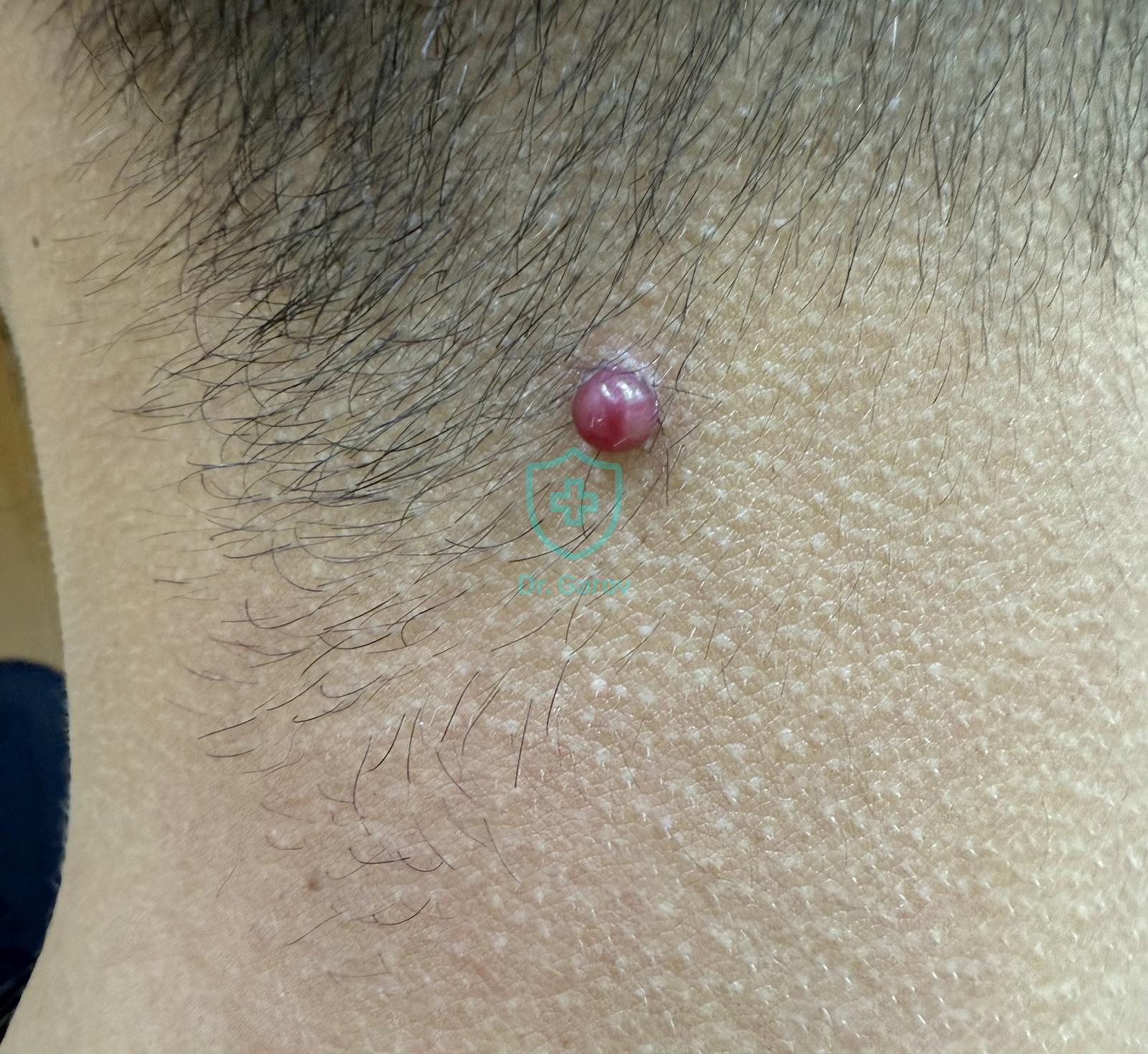 Granuloma pyogenicum