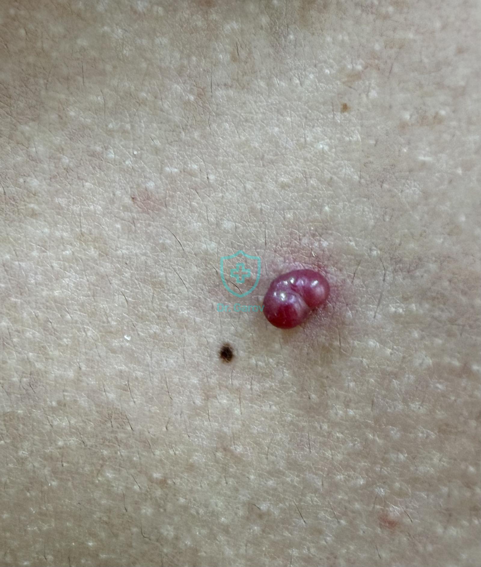 Granuloma pyogenicum