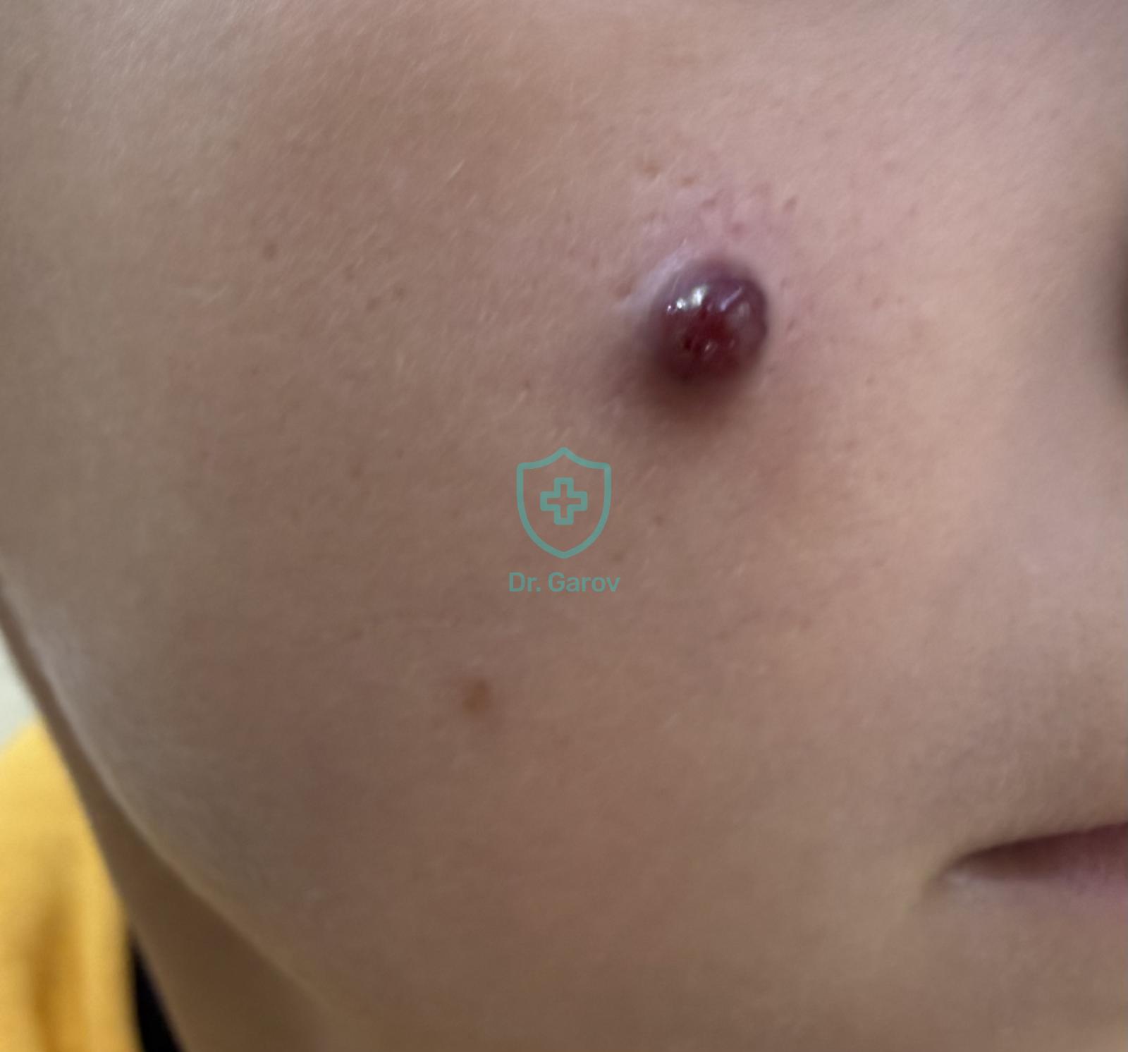 Granuloma pyogenicum