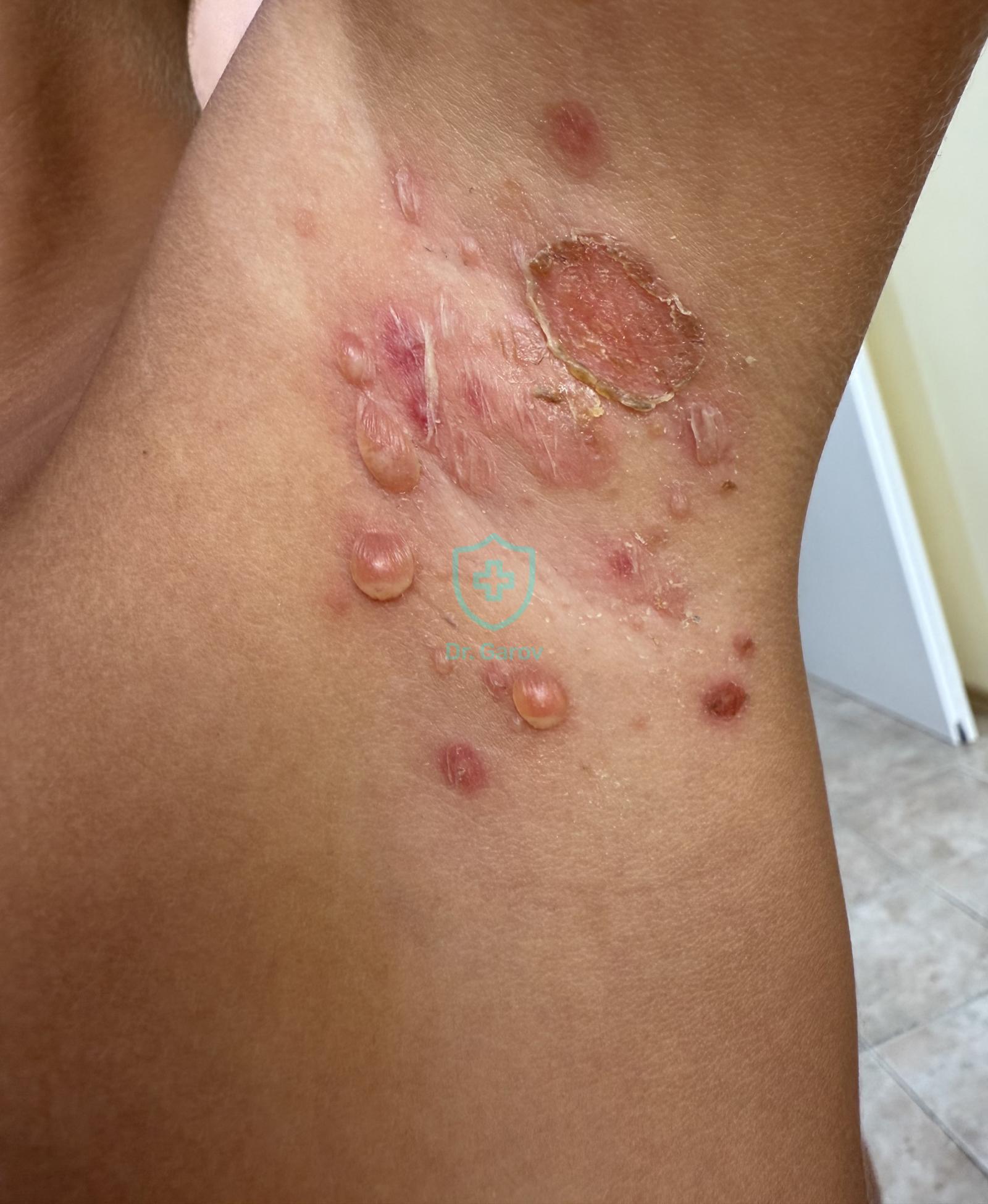 Impetigo bullosa