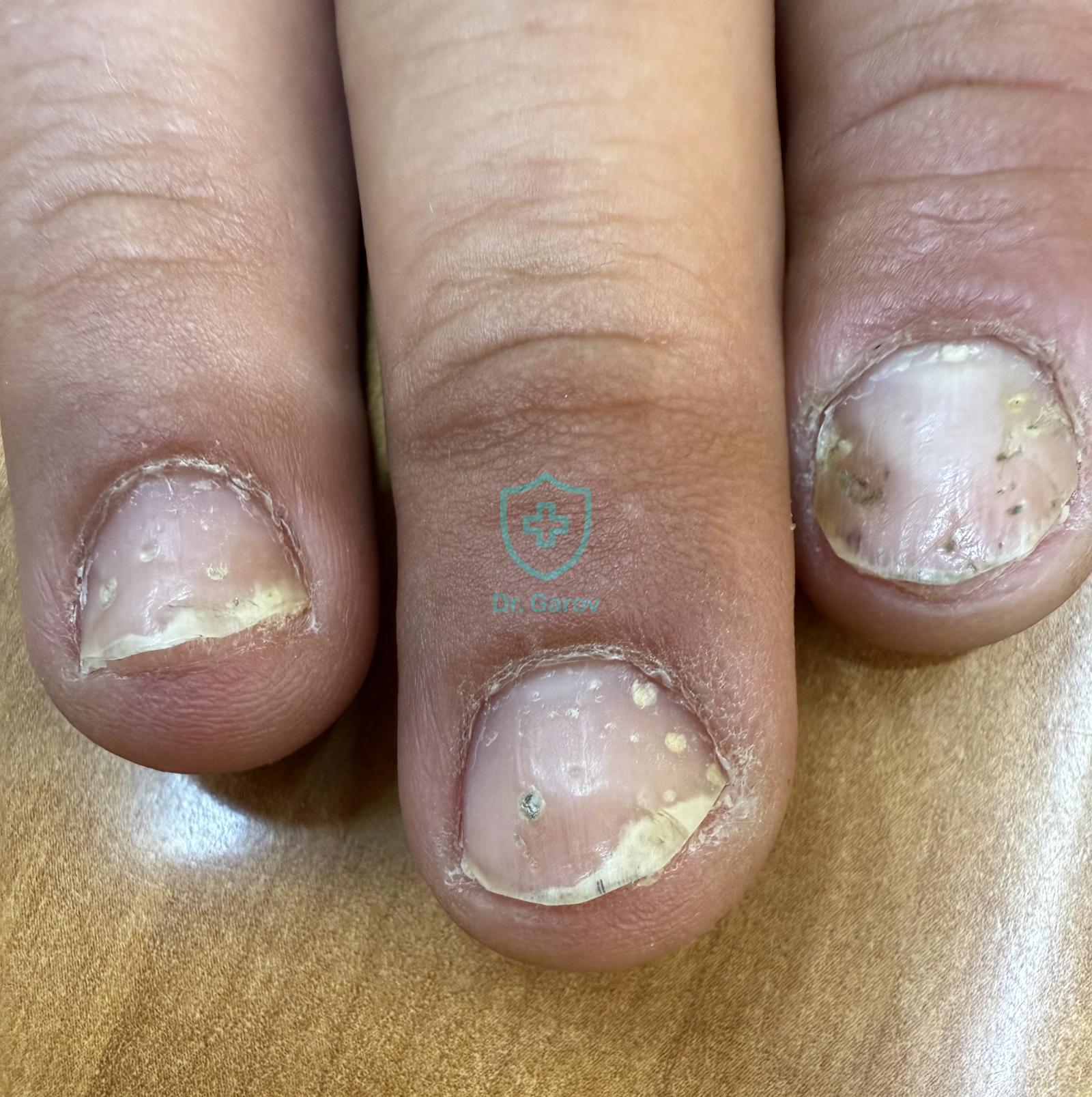 Psoriasis vulgaris - точковидни депресии, симптом на напръстника