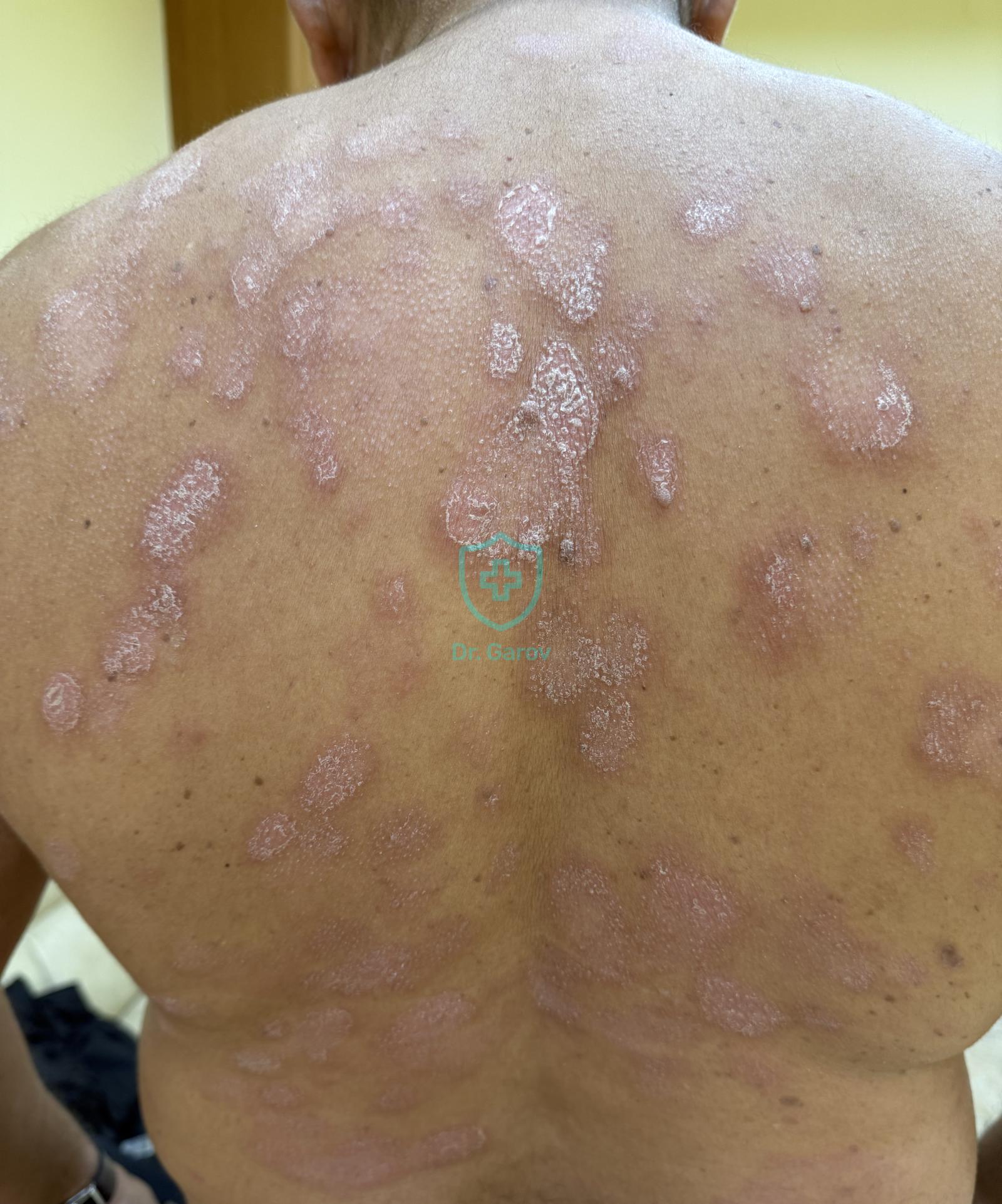Psoriasis nummularis