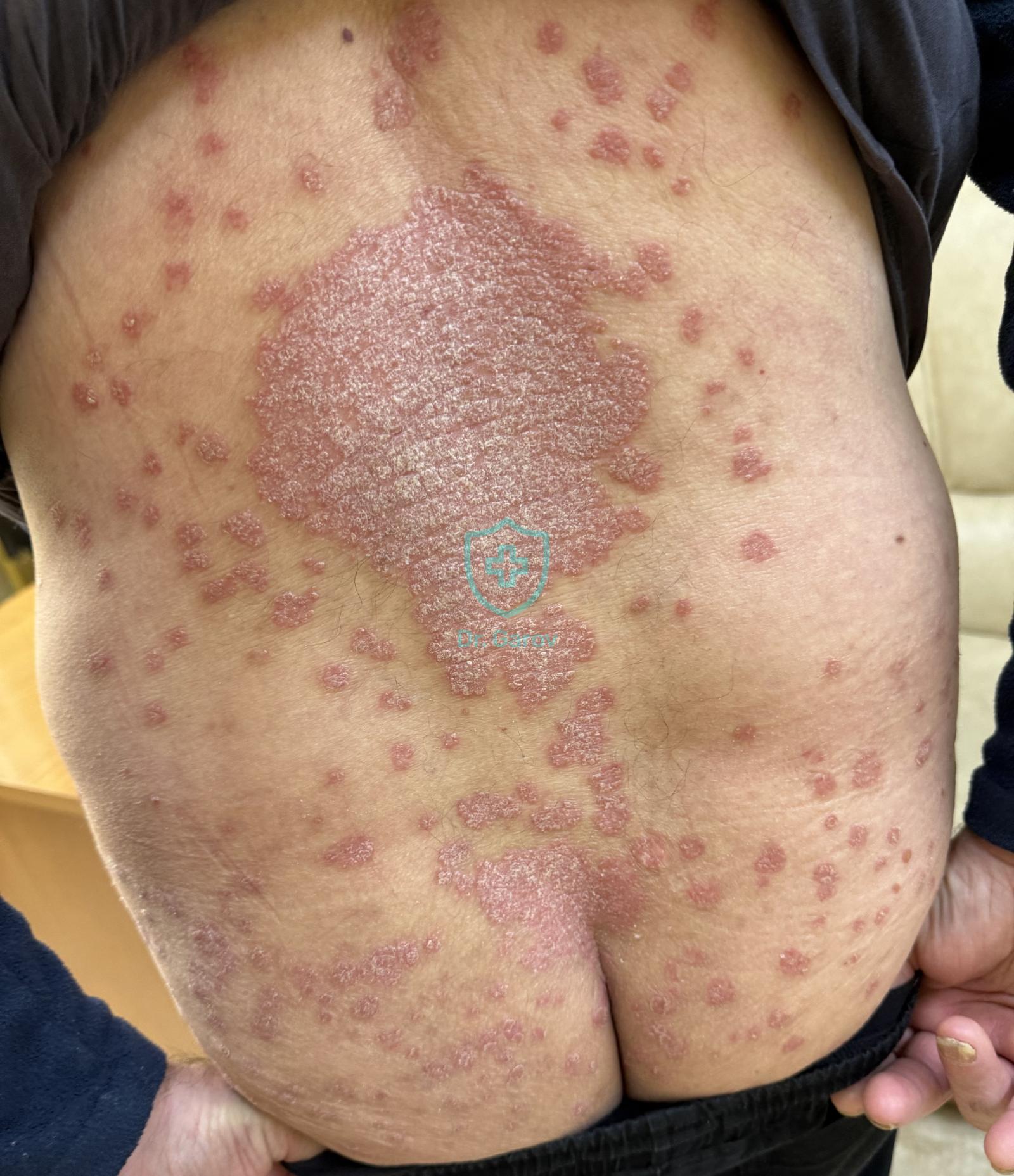 Psoriasis vulgaris