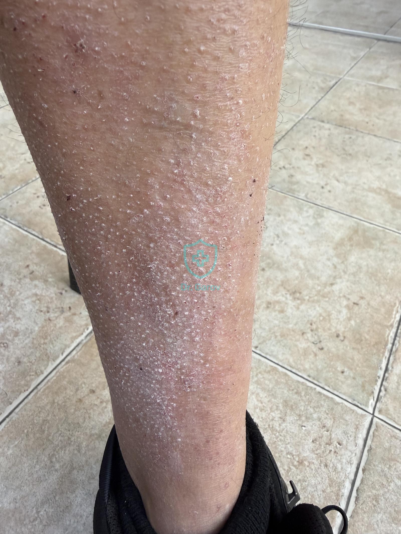 Psoriasis follicularis