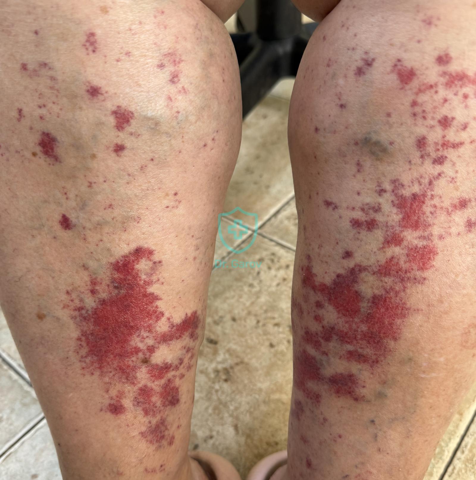 Exercise-induced capillaritis