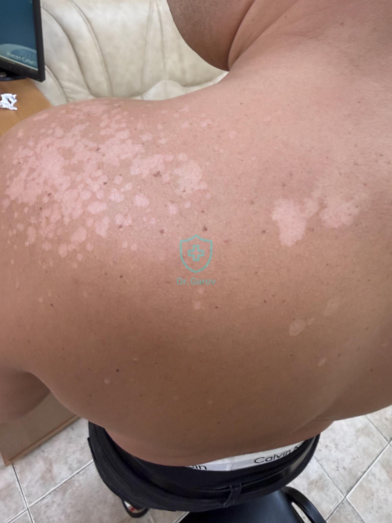 Pityriasis versicolor alba