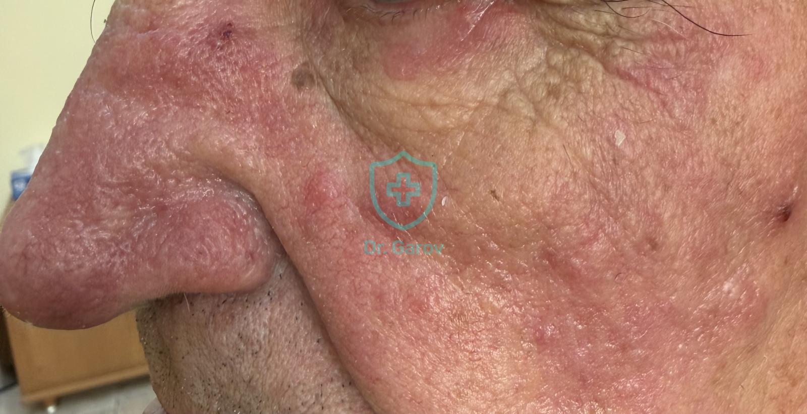 Rosacea - папуло-пустулозна форма