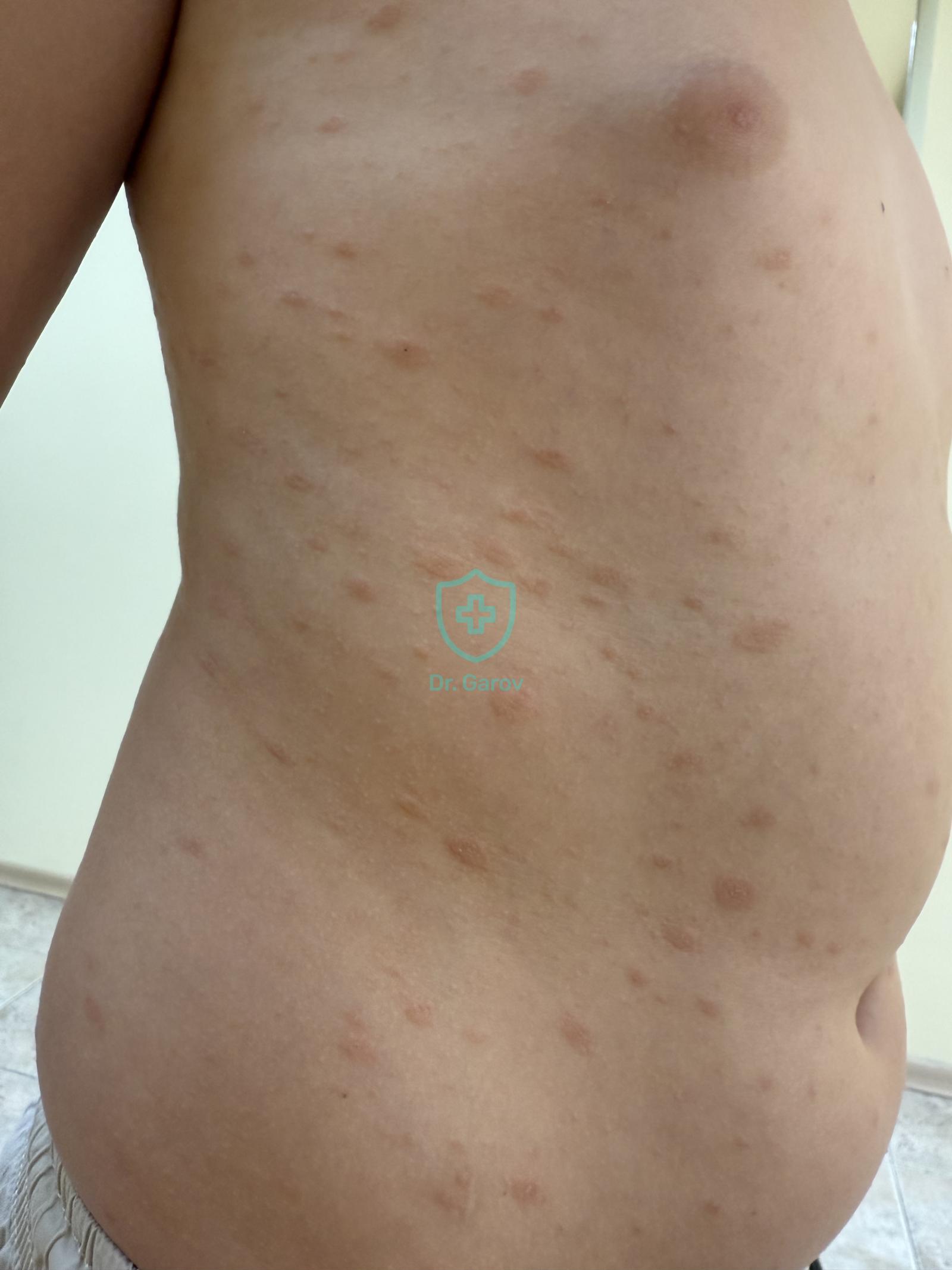 Pityriasis rosea Gibert