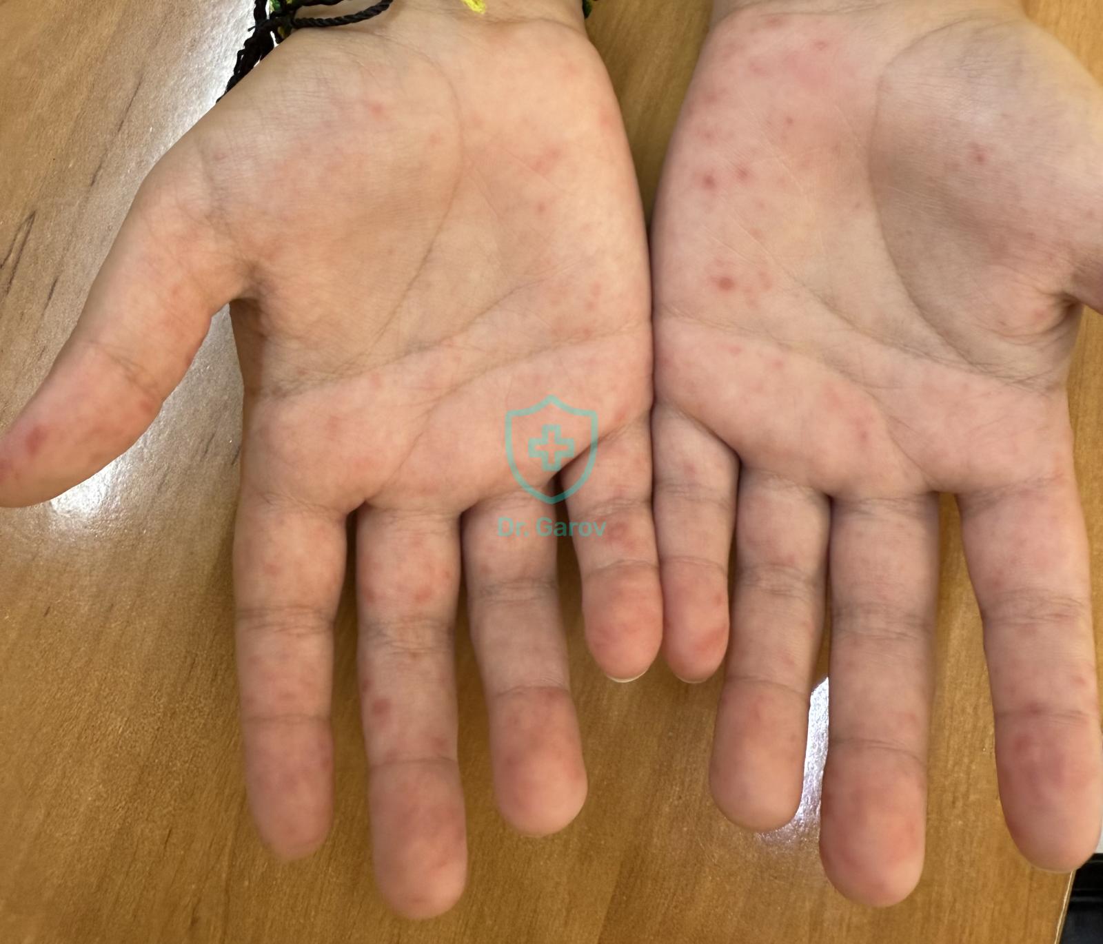 Hand, foot, and mouth disease