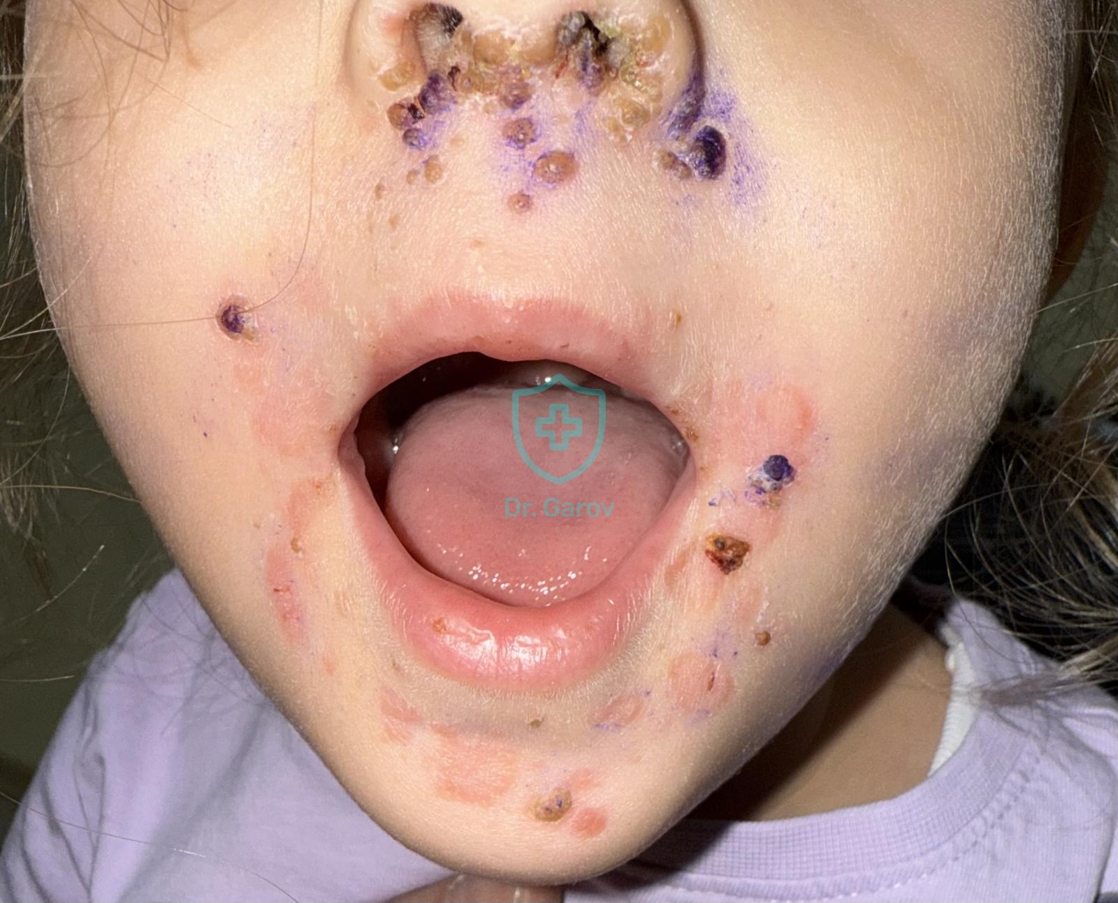 Hand, foot, and mouth disease