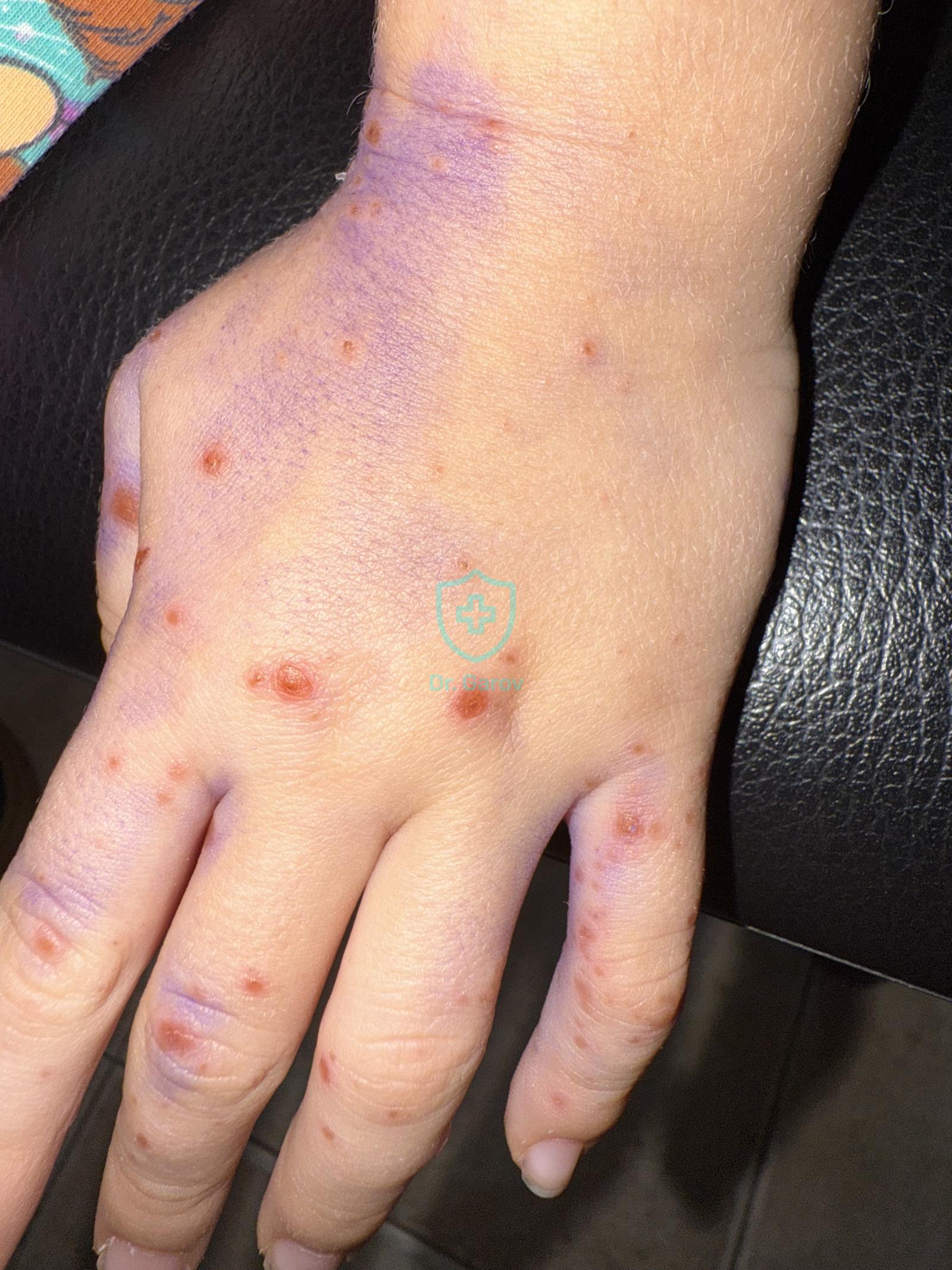 Hand, foot, and mouth disease
