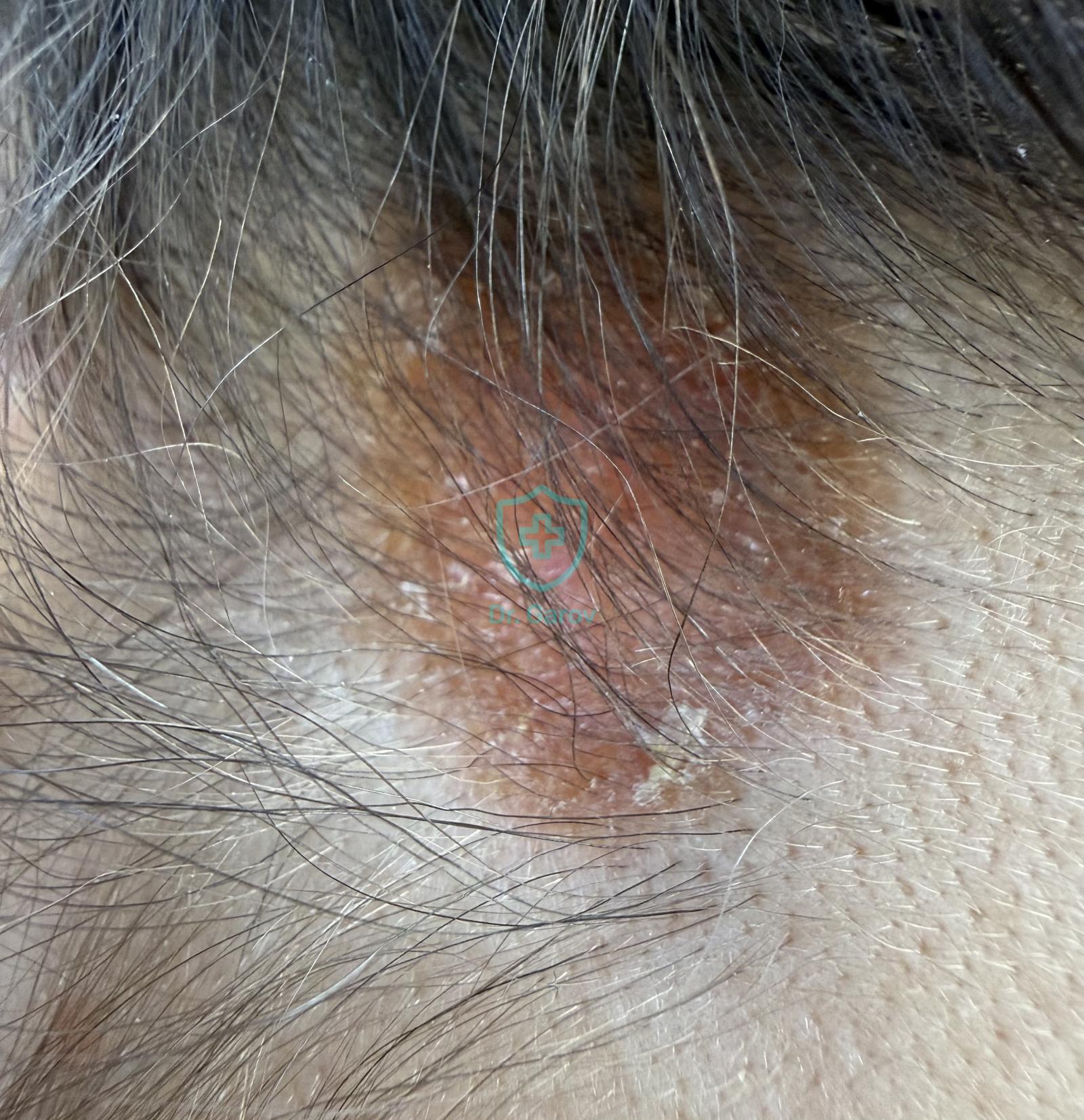 Sarcoidosis