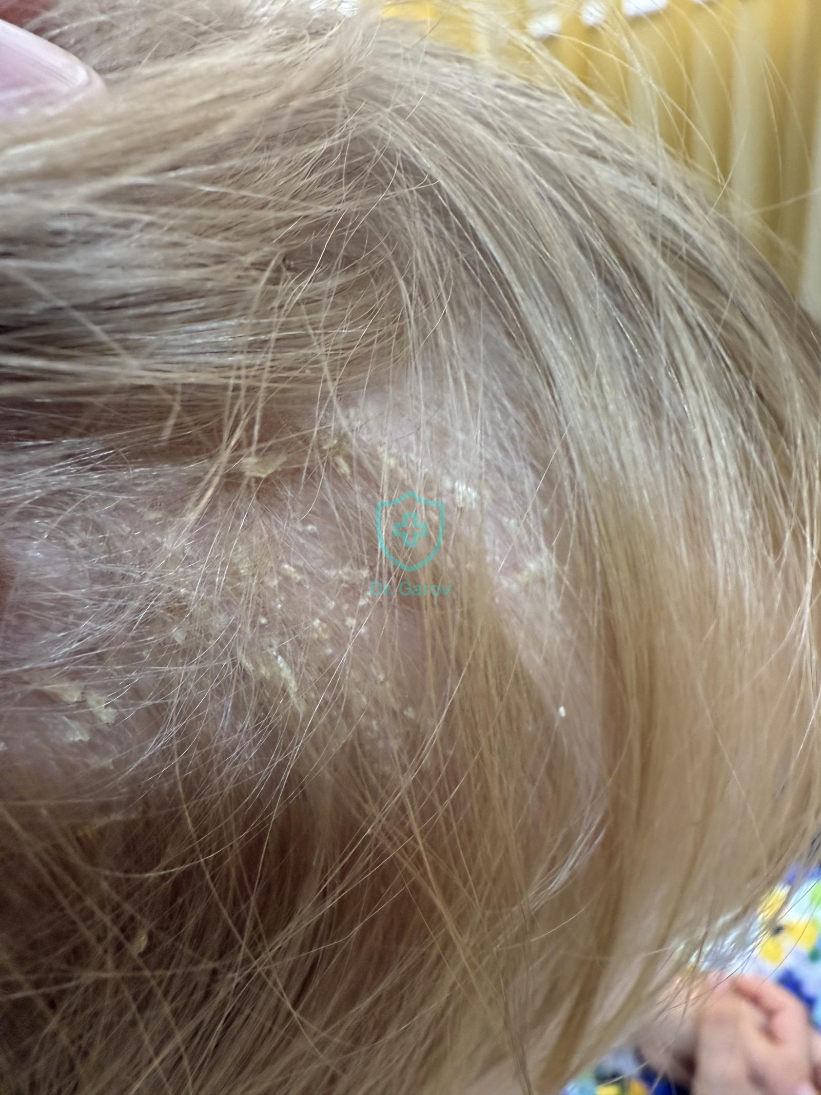 Dermatitis seborrhoides - Pseudotinea amiantacea