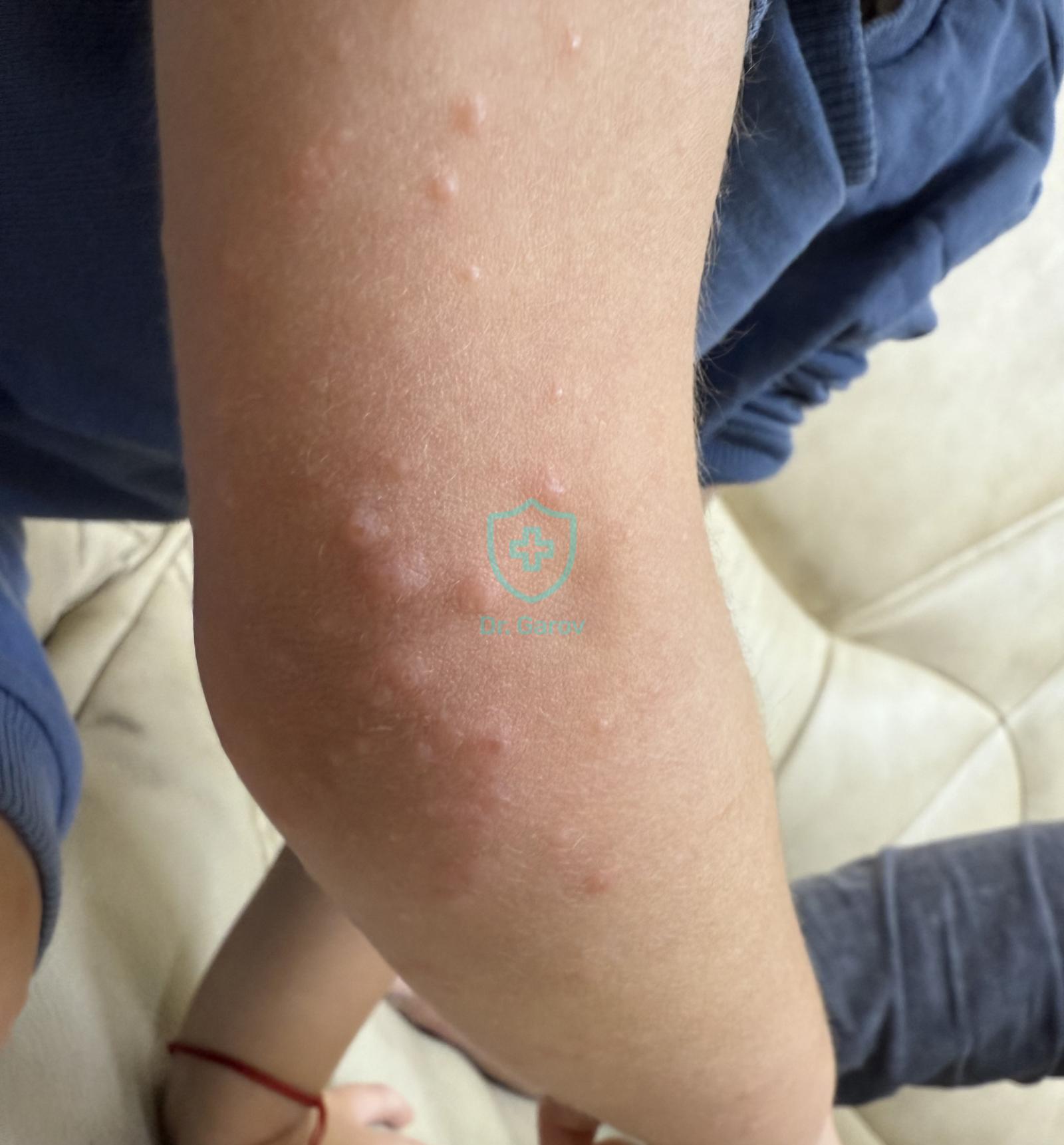 Gianotti–Crosti syndrome
