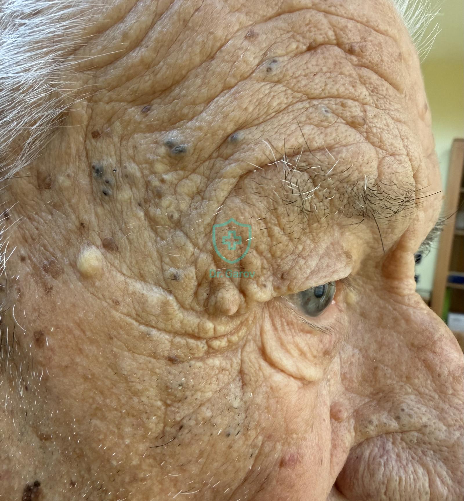 Syndroma Favre-Racouchot, Elastoidosis nodularis cystica et comedonica