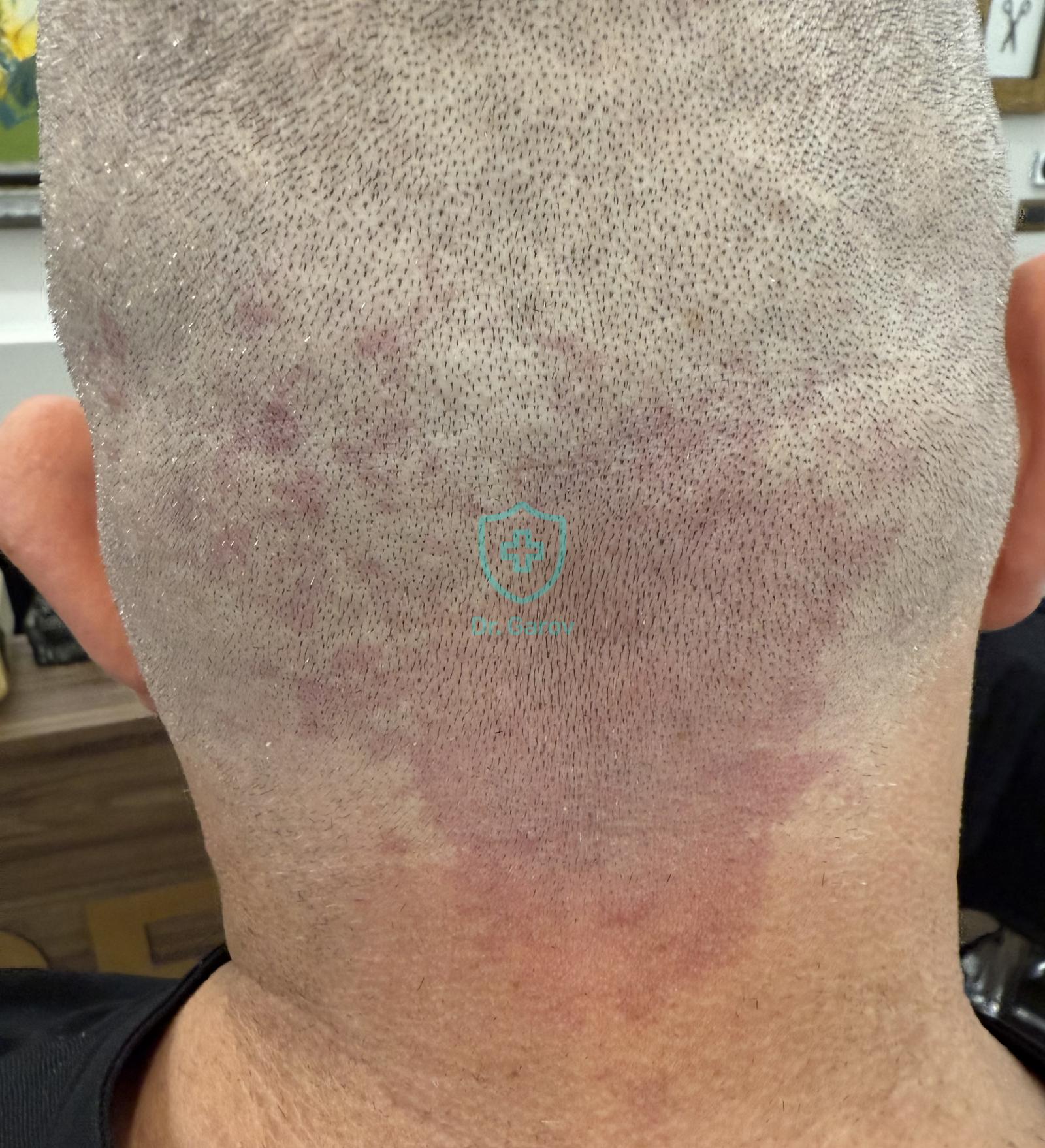 Teleangiectasia congenita nuchae, Nevus simplex