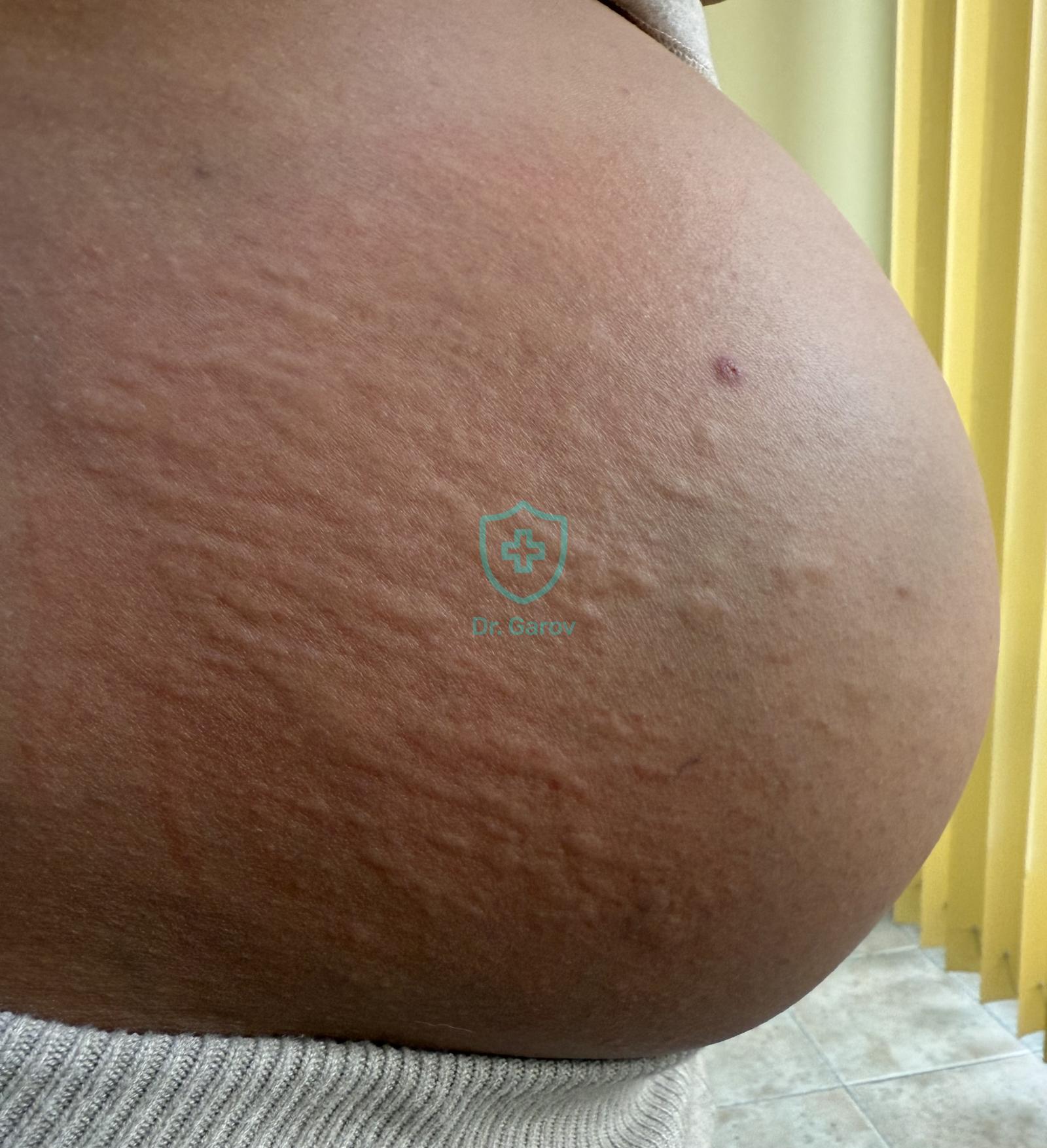 Urticaria gravidarum