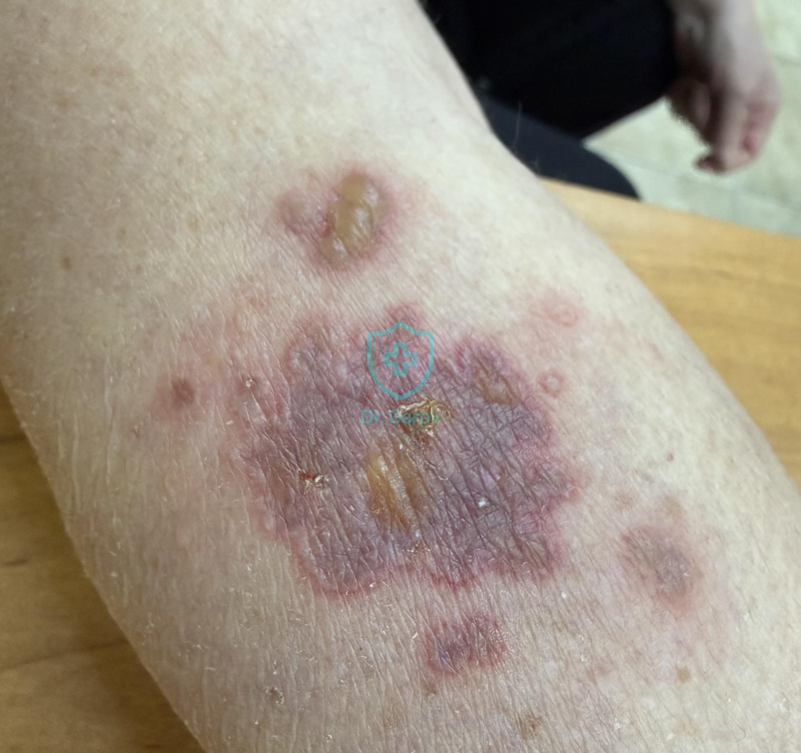 Erythema fixum