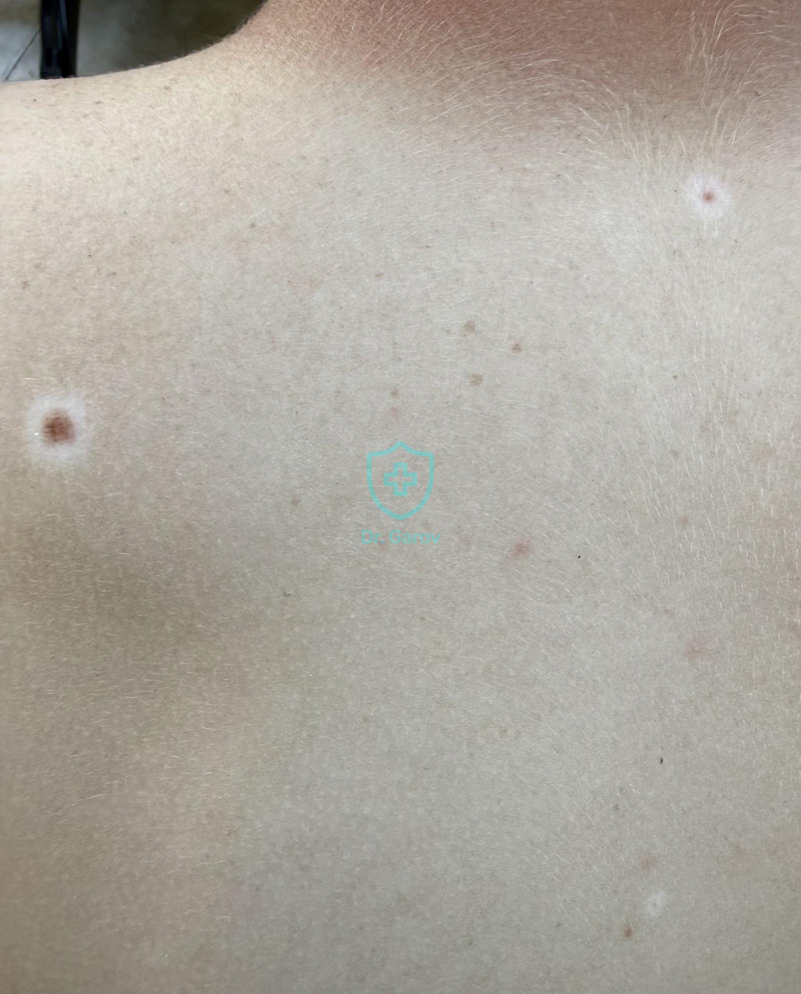 Naevus Sutton, Leucoderma centrifugum acquisitum
