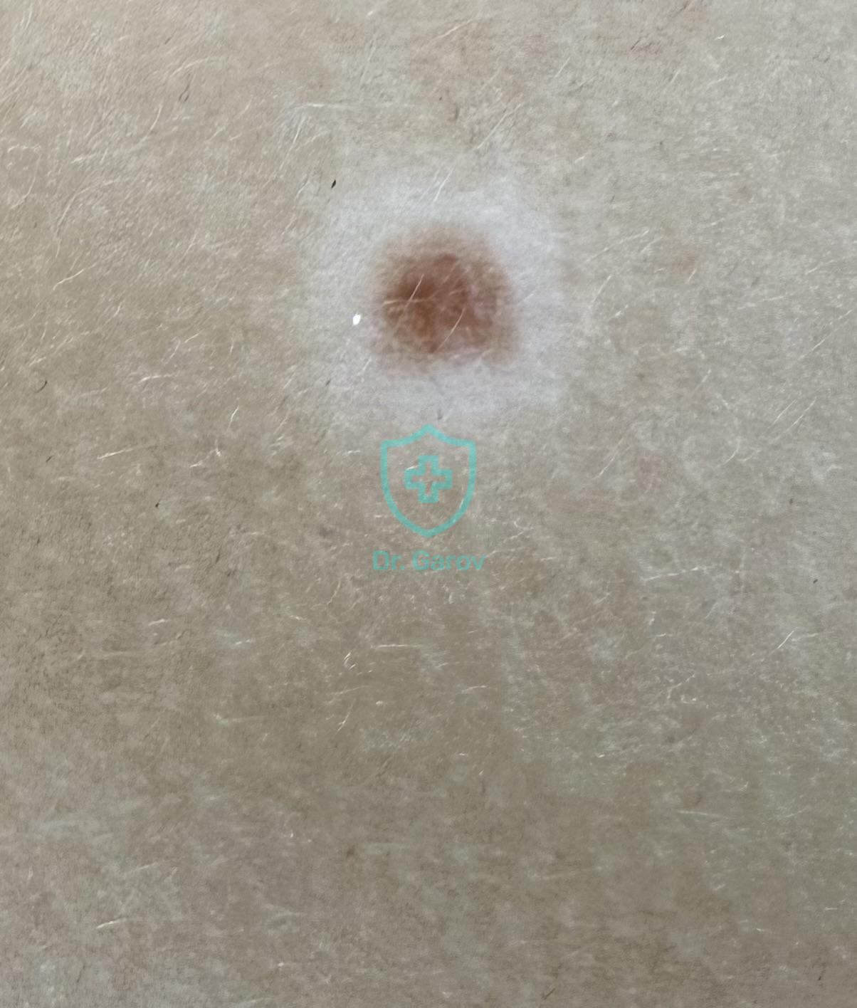 Naevus Sutton, Leucoderma centrifugum acquisitum