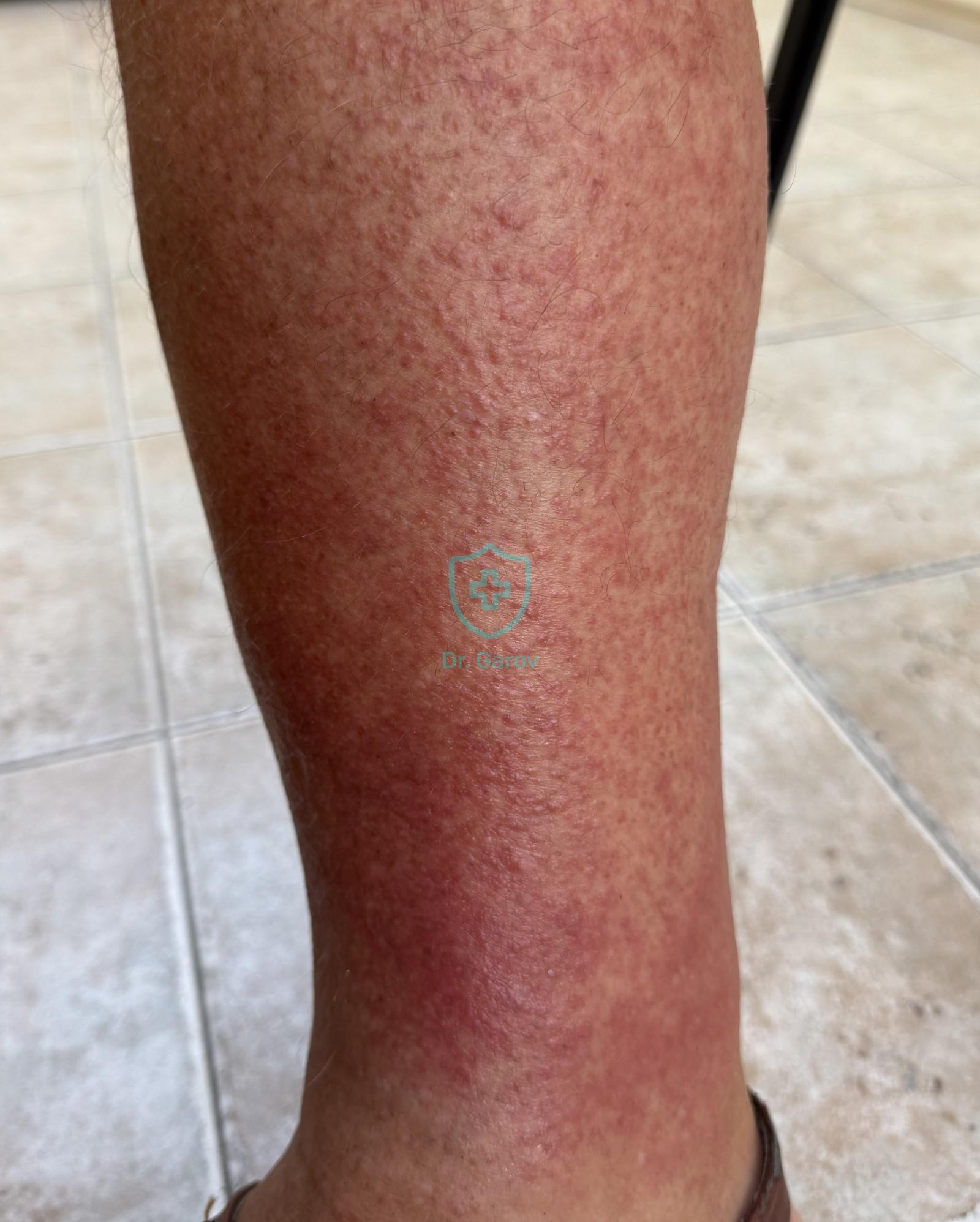 Purpura orthostatica