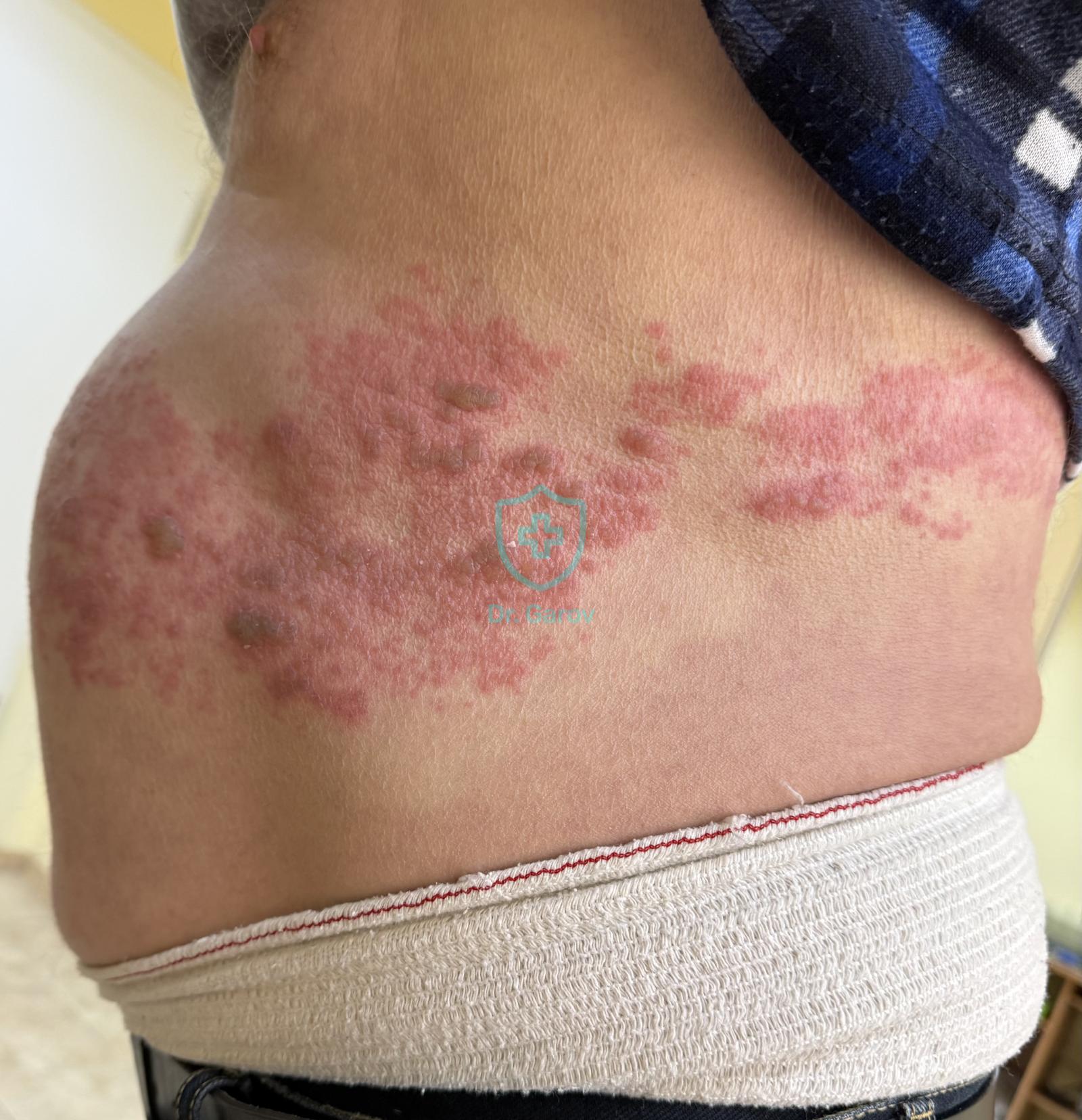 Herpes zoster lumbo-abdominalis