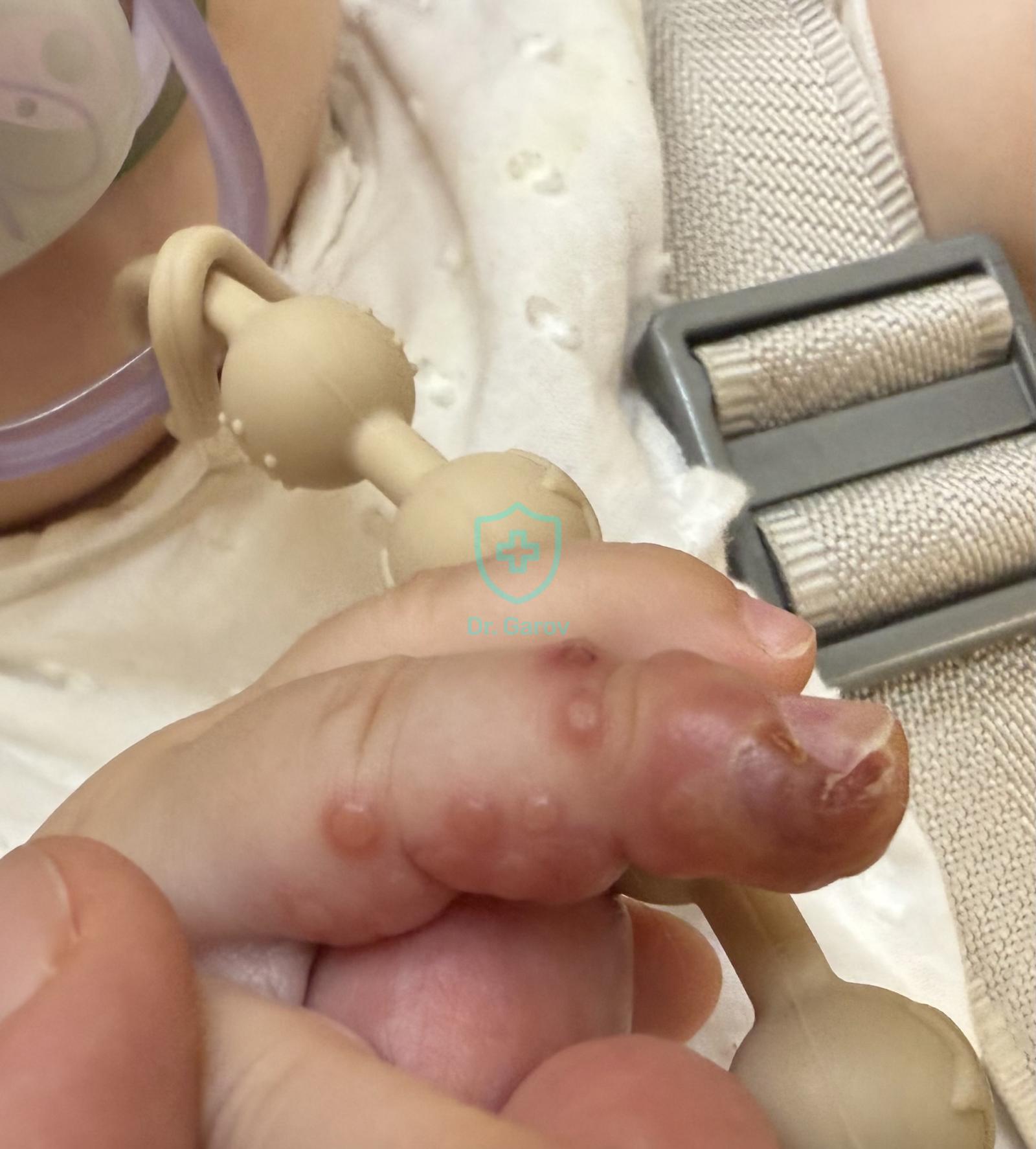 Herpes simplex