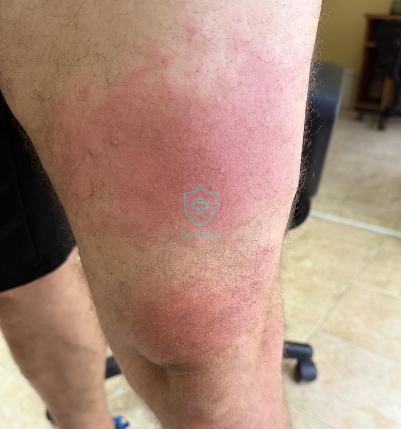 Cellulitis